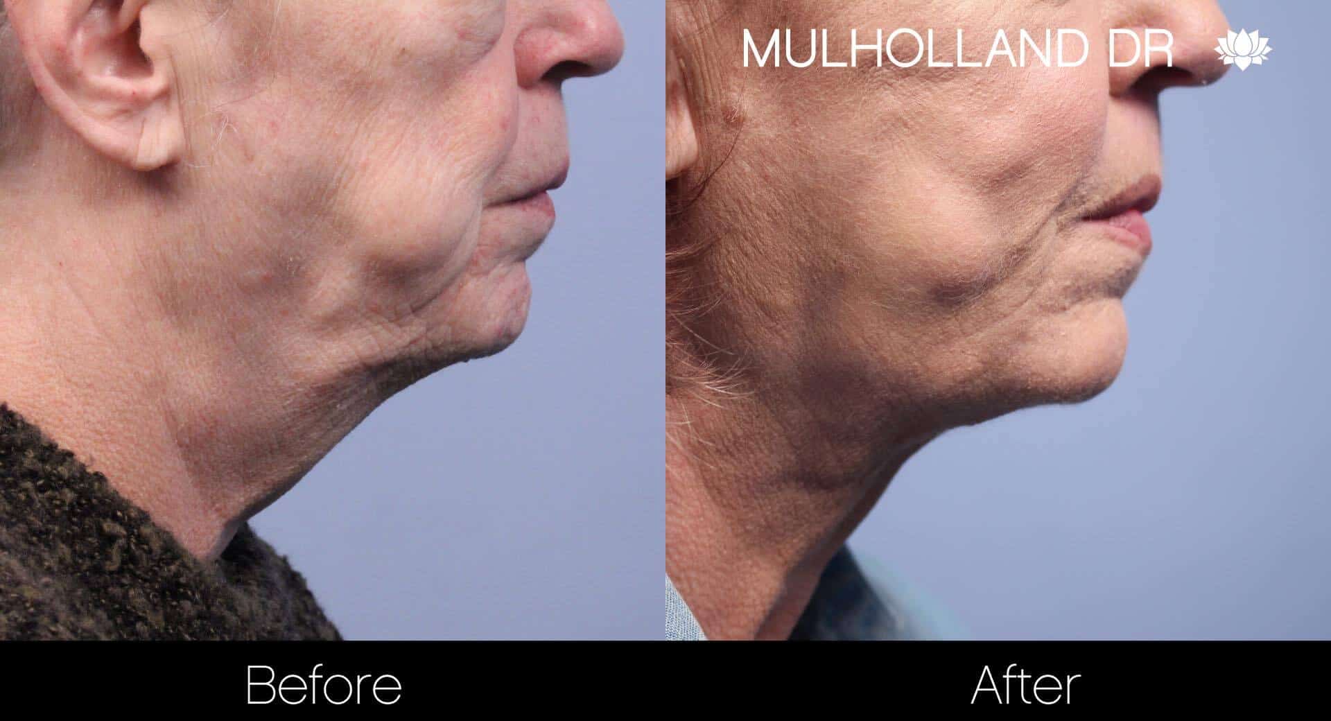 Neck Lift - Before and After Gallery - Patient Photo 104