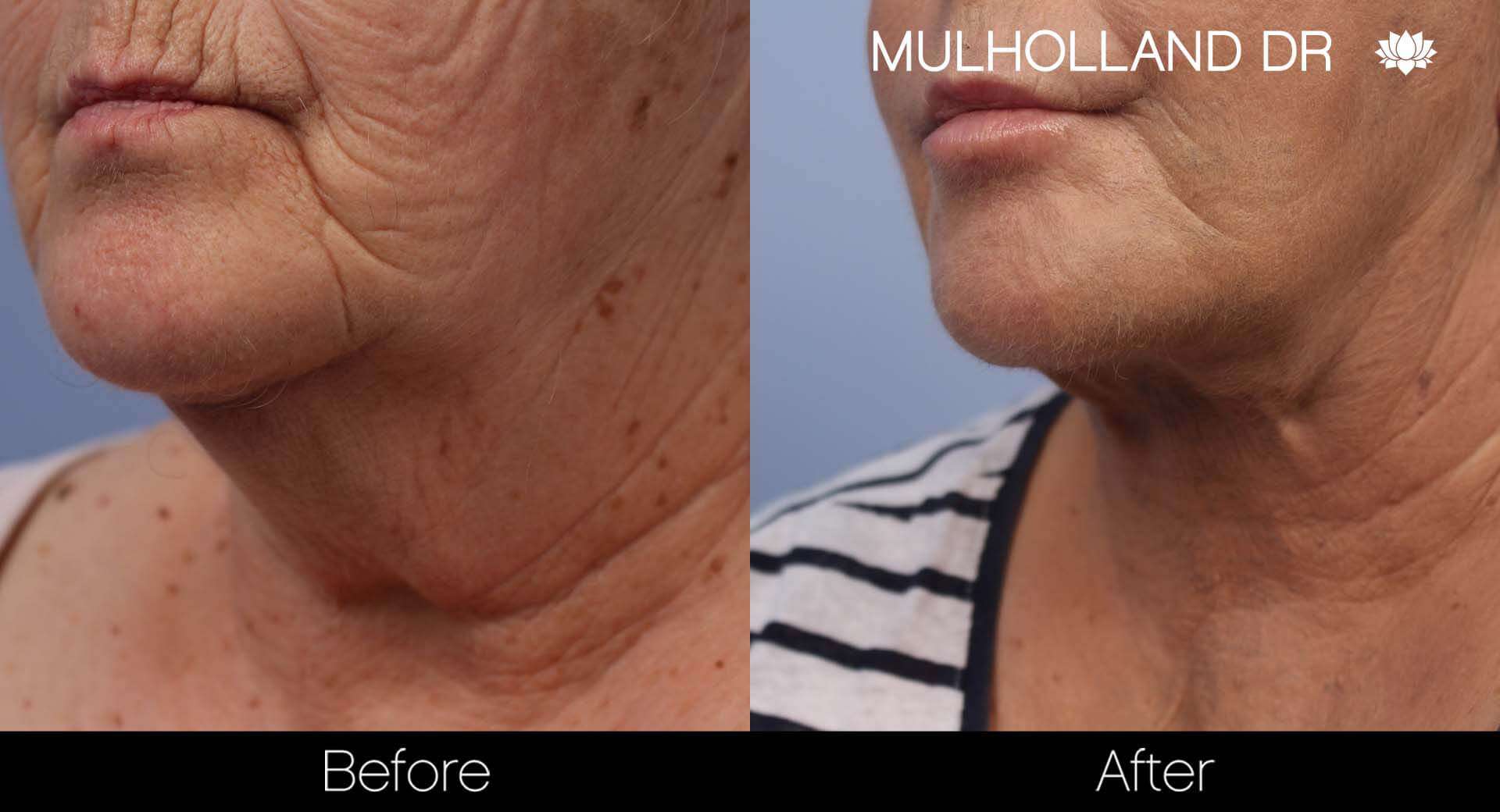 Neck Lift - Before and After Gallery - Patient Photo 123