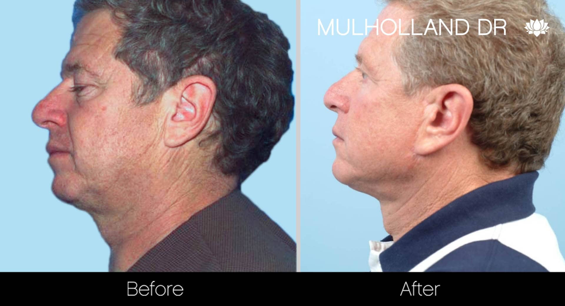 Neck Lift - Before and After Gallery - Patient Photo 128