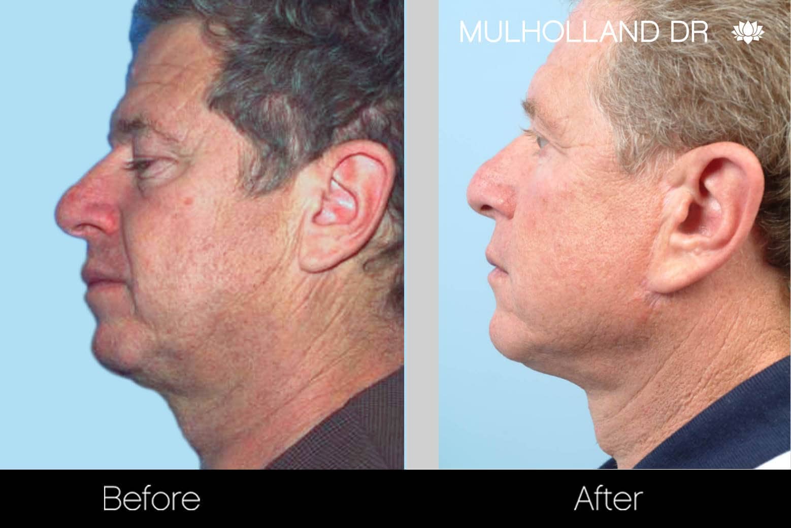 Neck Lift - Before and After Gallery - Patient Photo 129