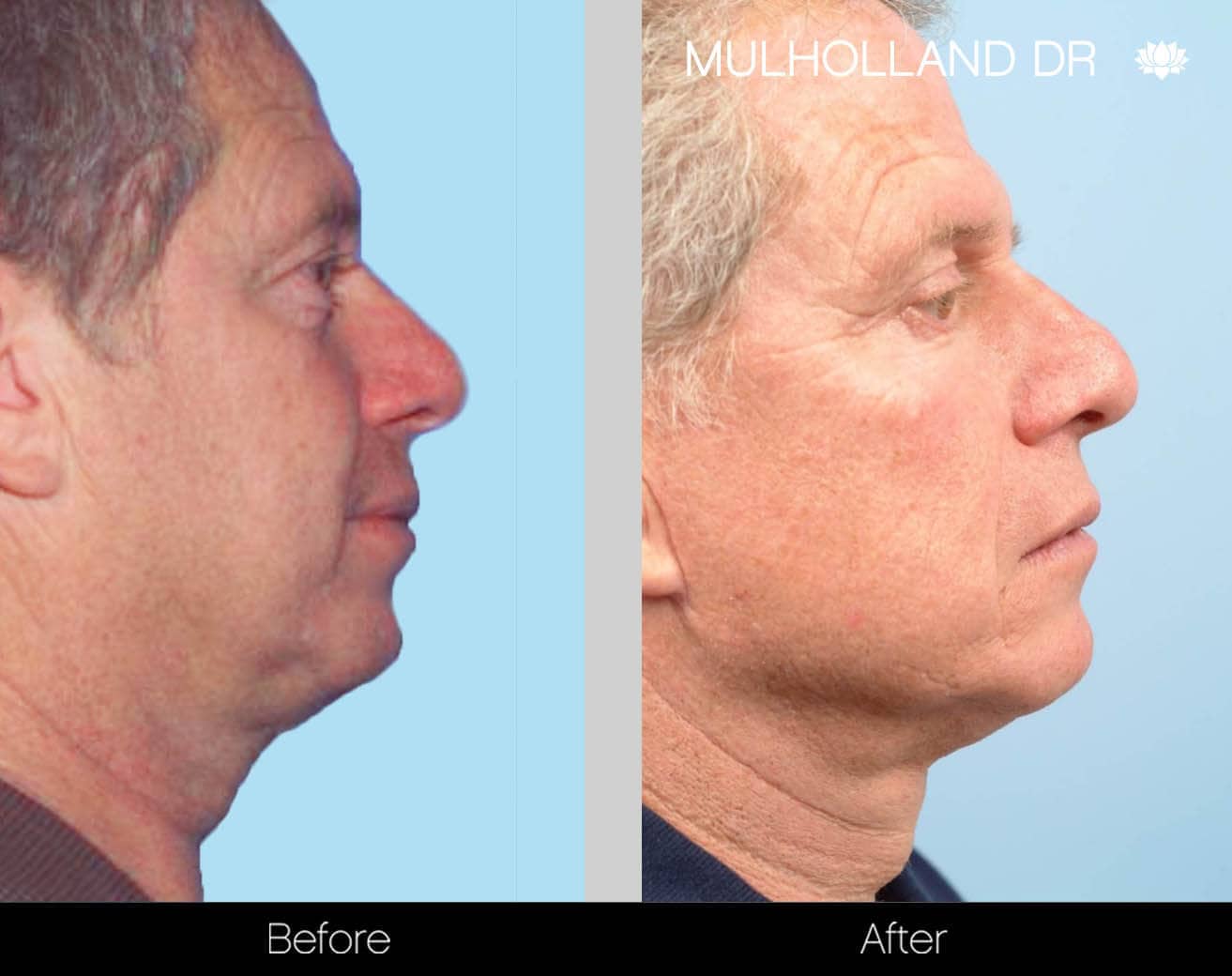 Neck Lift - Before and After Gallery - Patient Photo 130