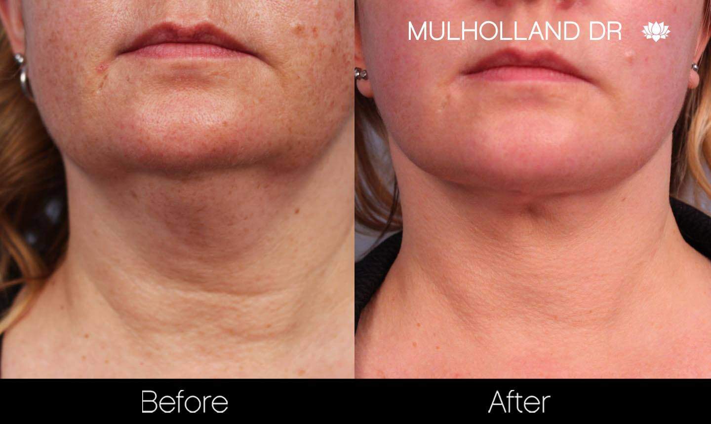 Neck Lift - Before and After Gallery - Patient Photo 131