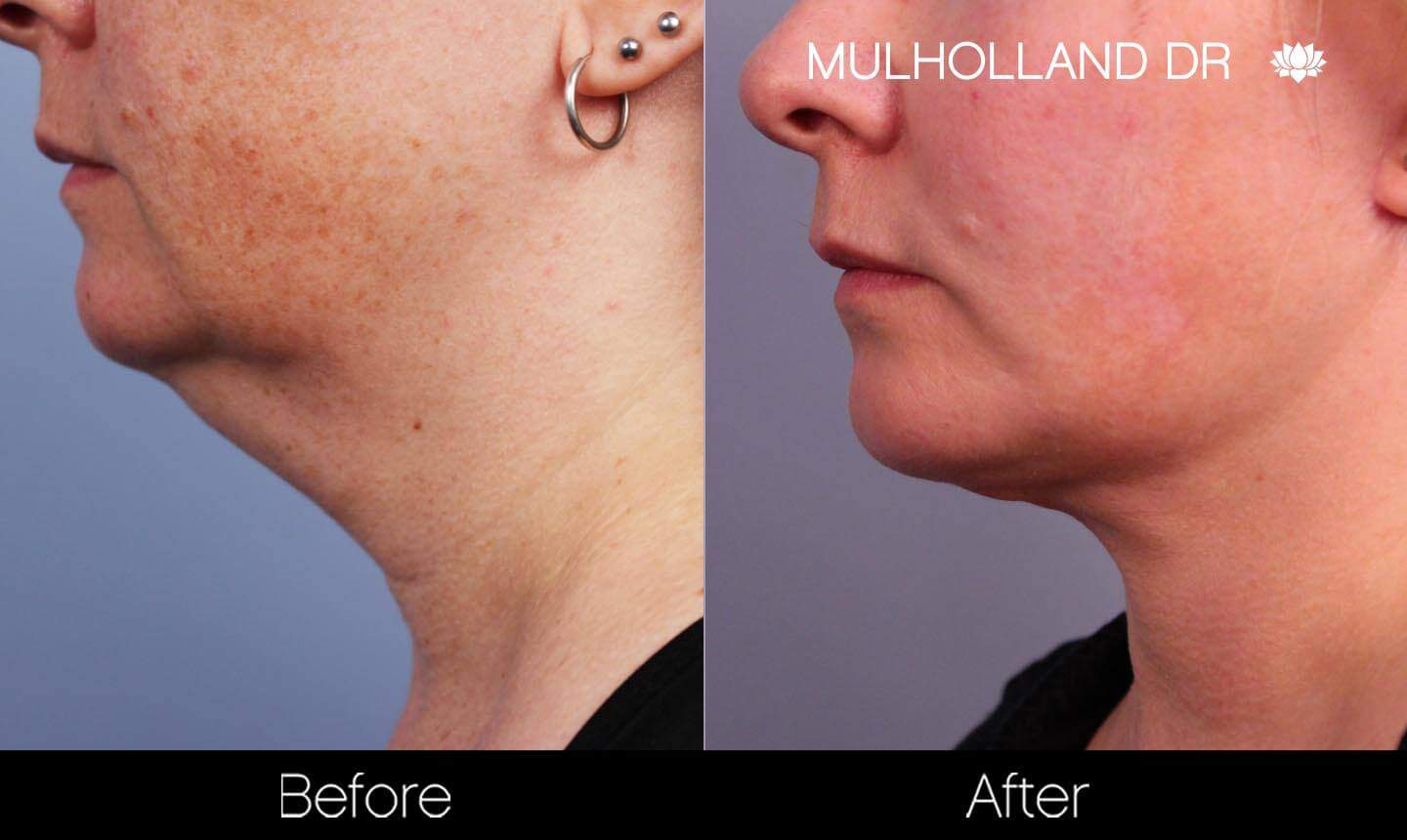 Neck Lift - Before and After Gallery - Patient Photo 132