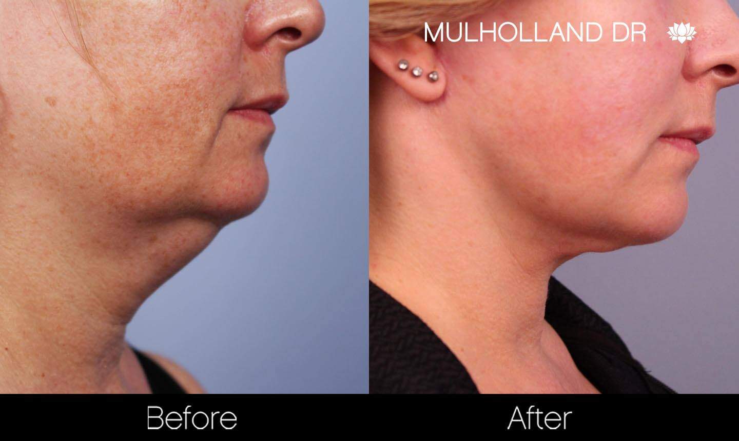 Neck Lift - Before and After Gallery - Patient Photo 134