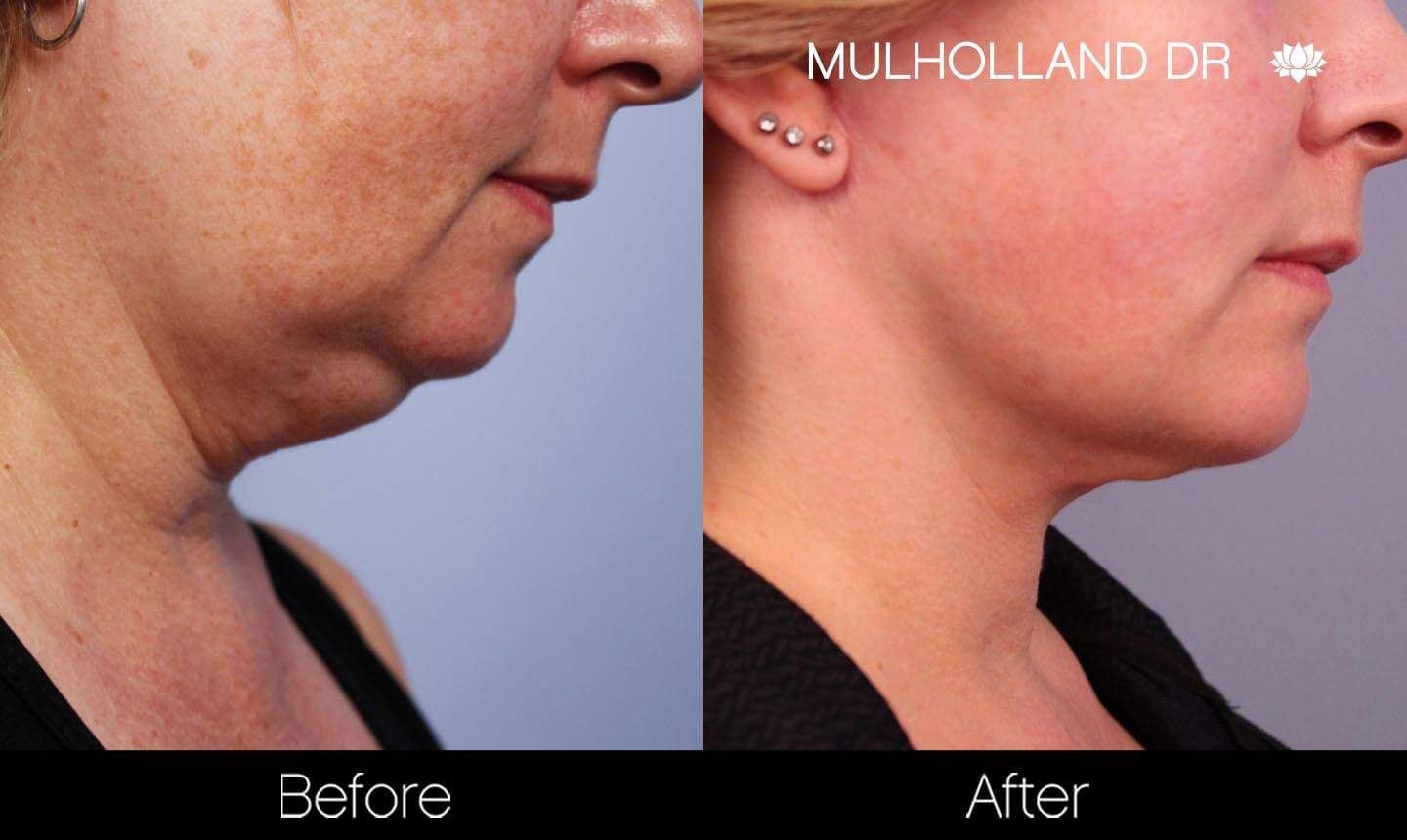 Neck Lift - Before and After Gallery - Patient Photo 135