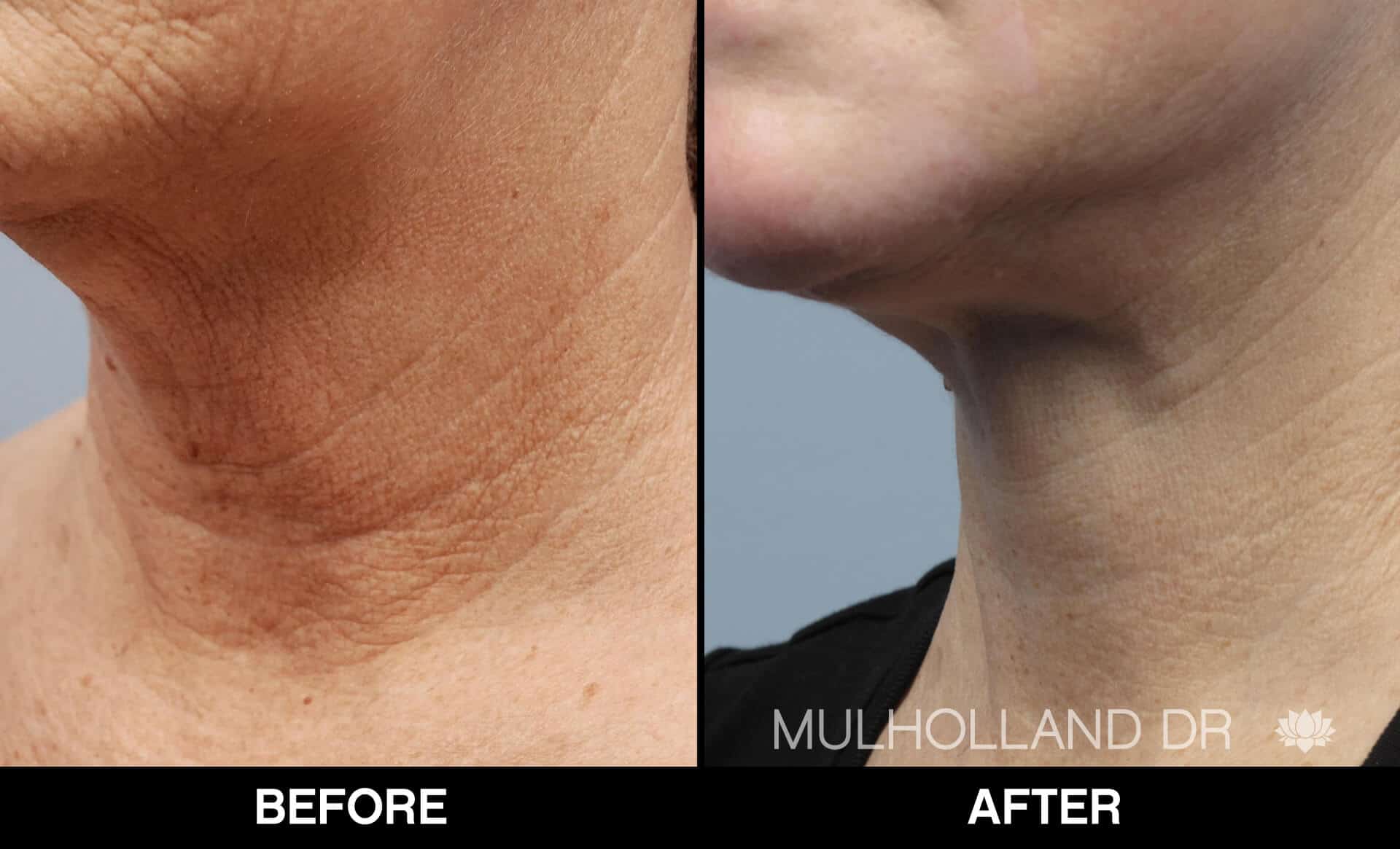 Neck Lift - Before and After Gallery - Patient Photo 14
