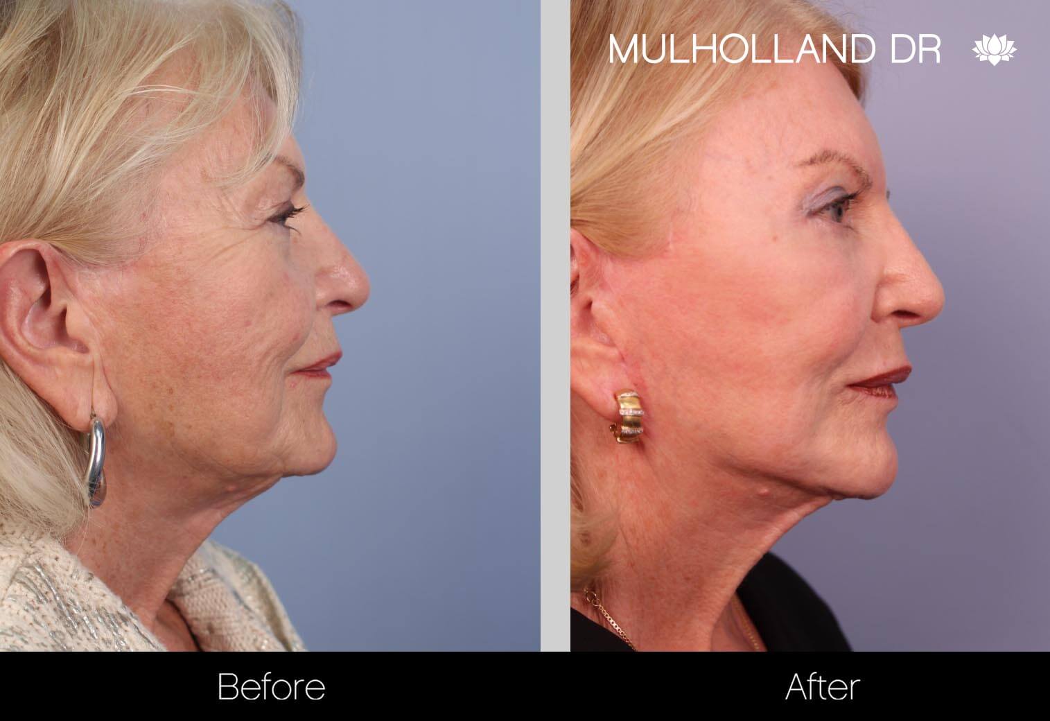Neck Lift - Before and After Gallery - Patient Photo 34