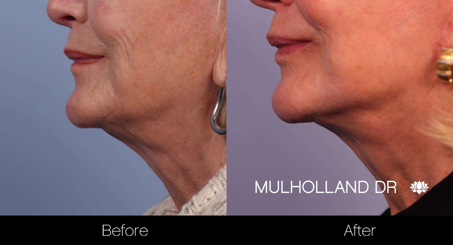 Neck Lift - Before and After Gallery - Patient Photo 36
