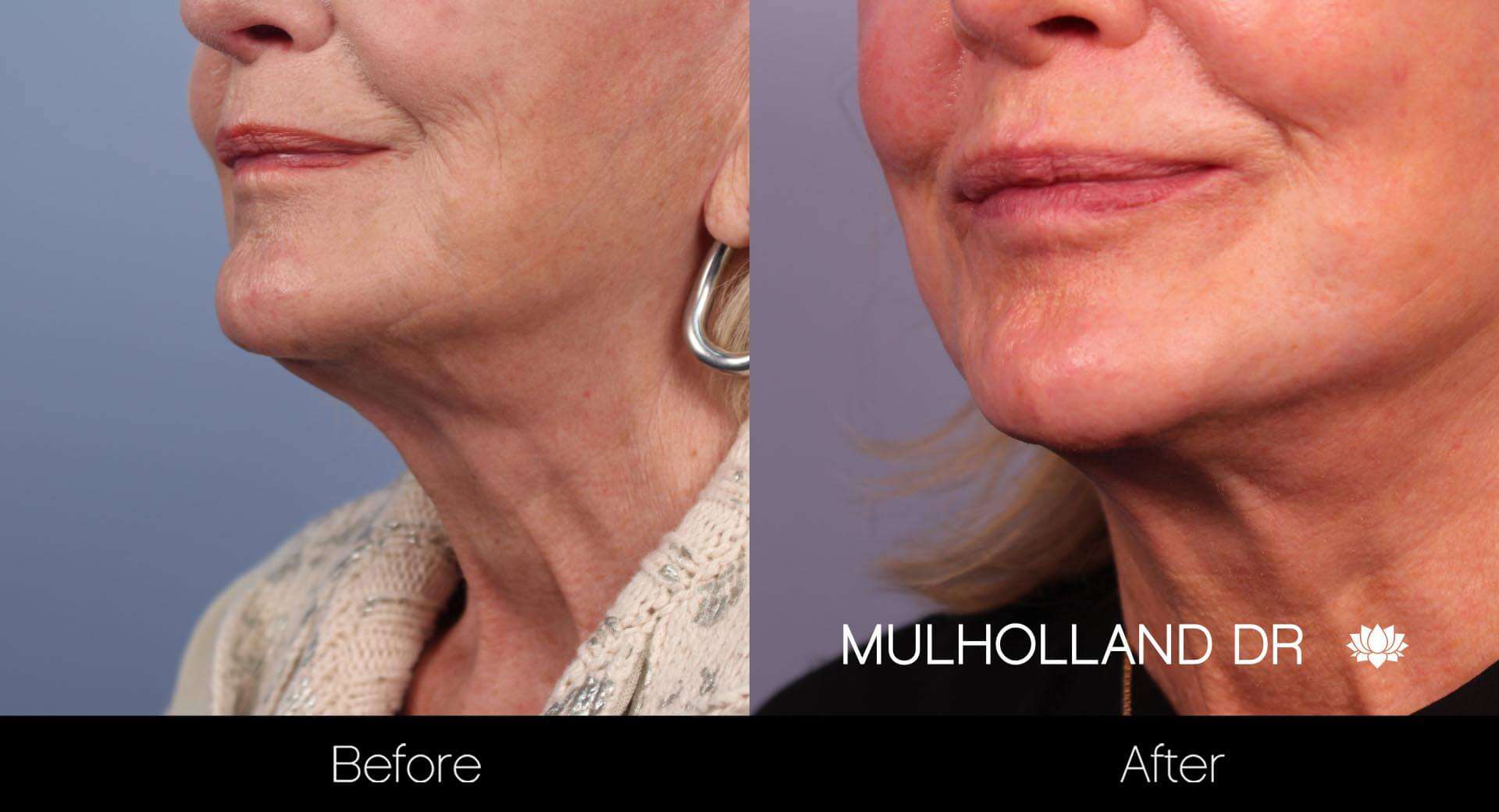 Neck Lift - Before and After Gallery - Patient Photo 37
