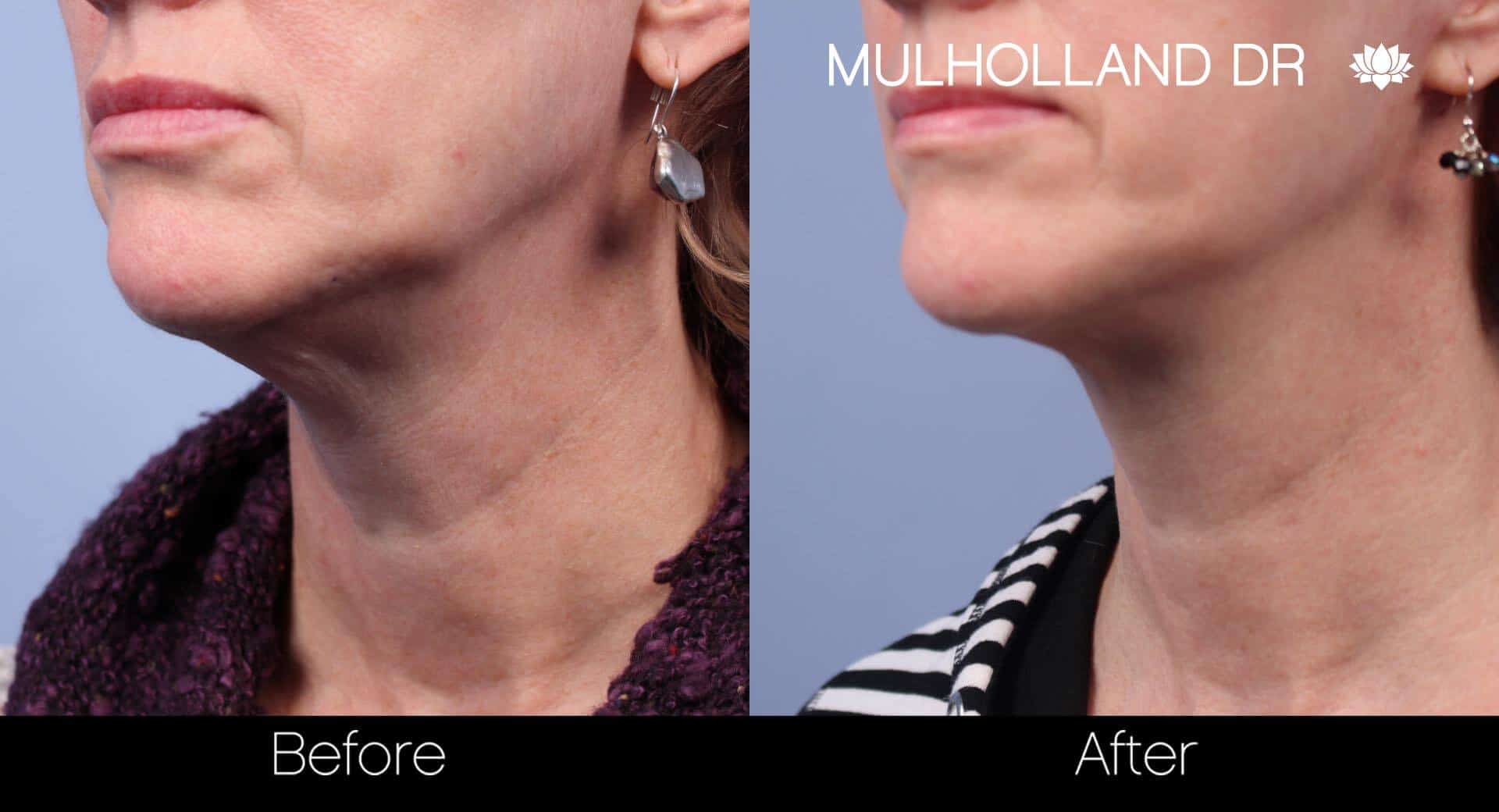 Neck Lift - Before and After Gallery - Patient Photo 43