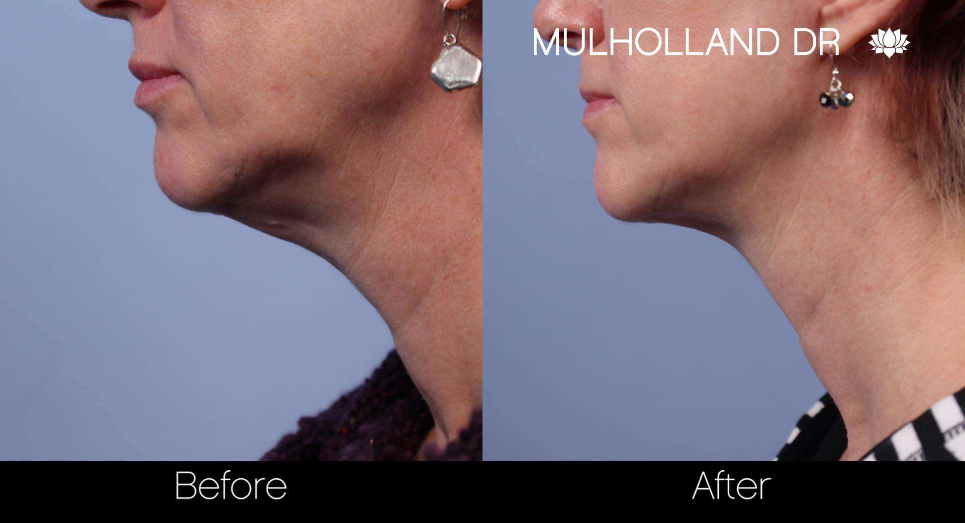 Neck Lift - Before and After Gallery - Patient Photo 45