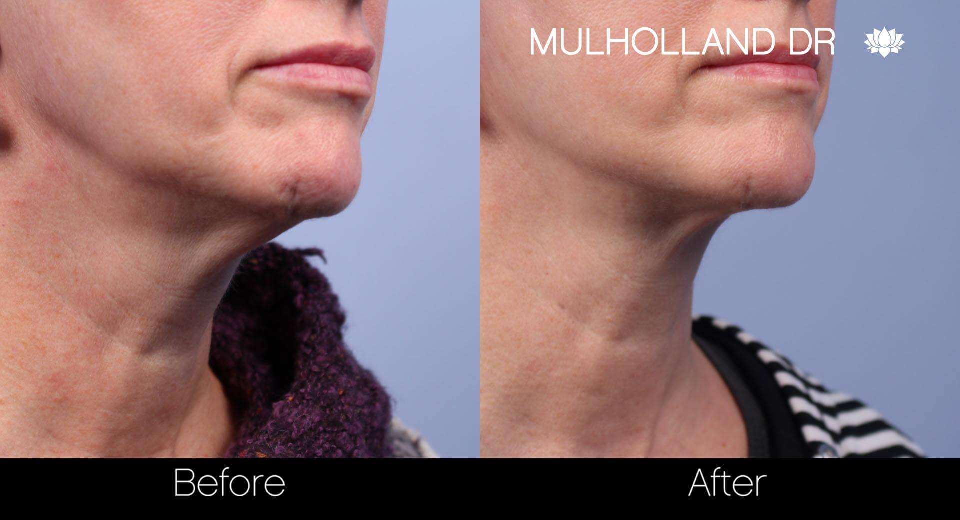 Neck Lift - Before and After Gallery - Patient Photo 46
