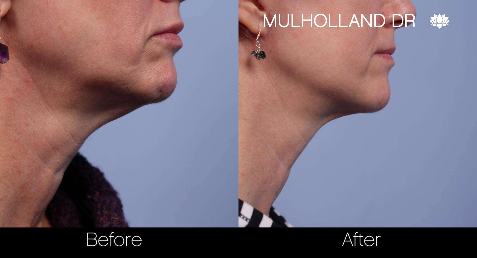 Neck Lift - Before and After Gallery - Patient Photo 47