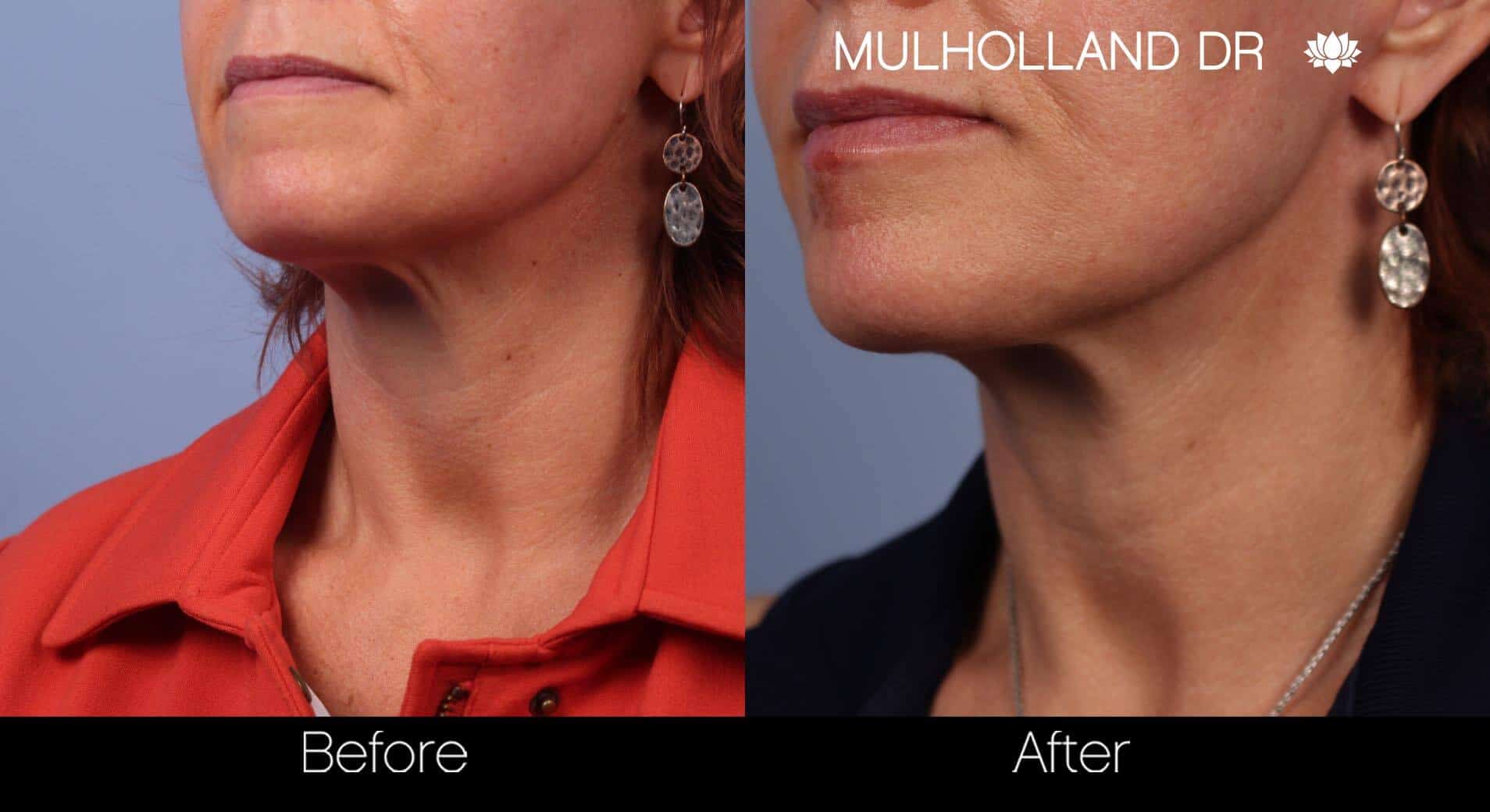Neck Lift - Before and After Gallery - Patient Photo 50