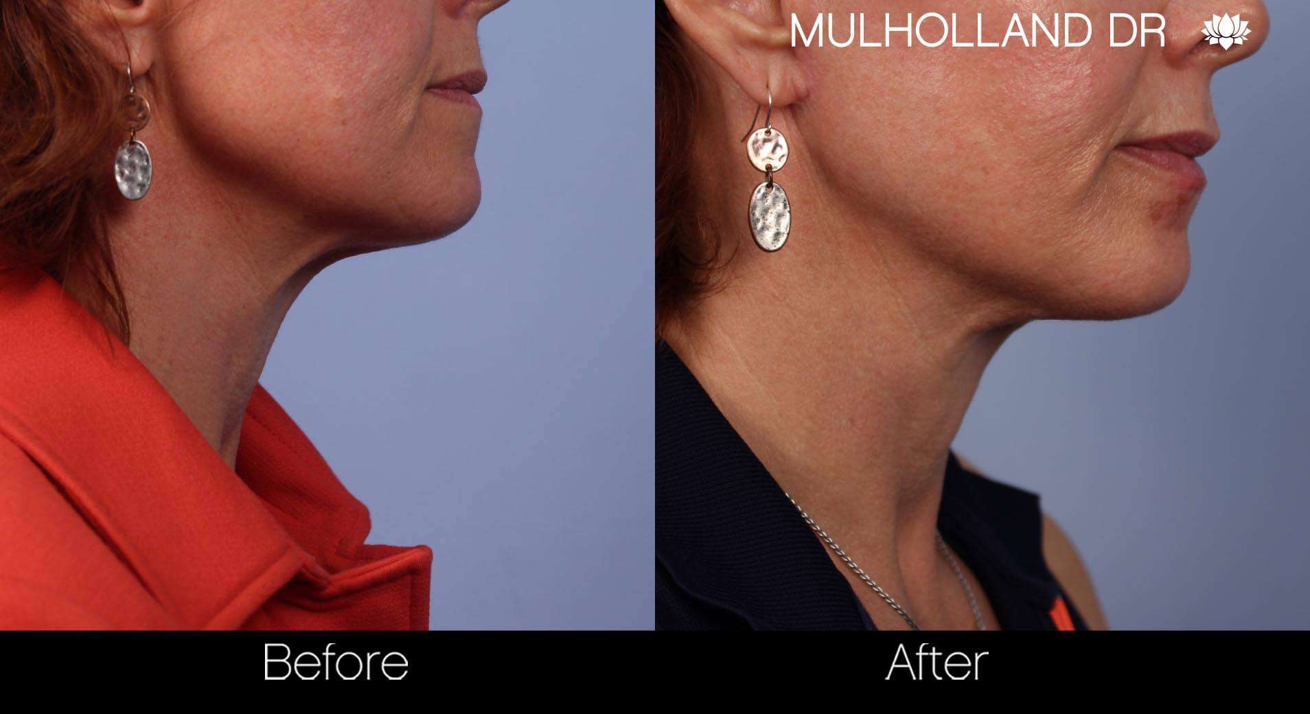 Neck Lift - Before and After Gallery - Patient Photo 52