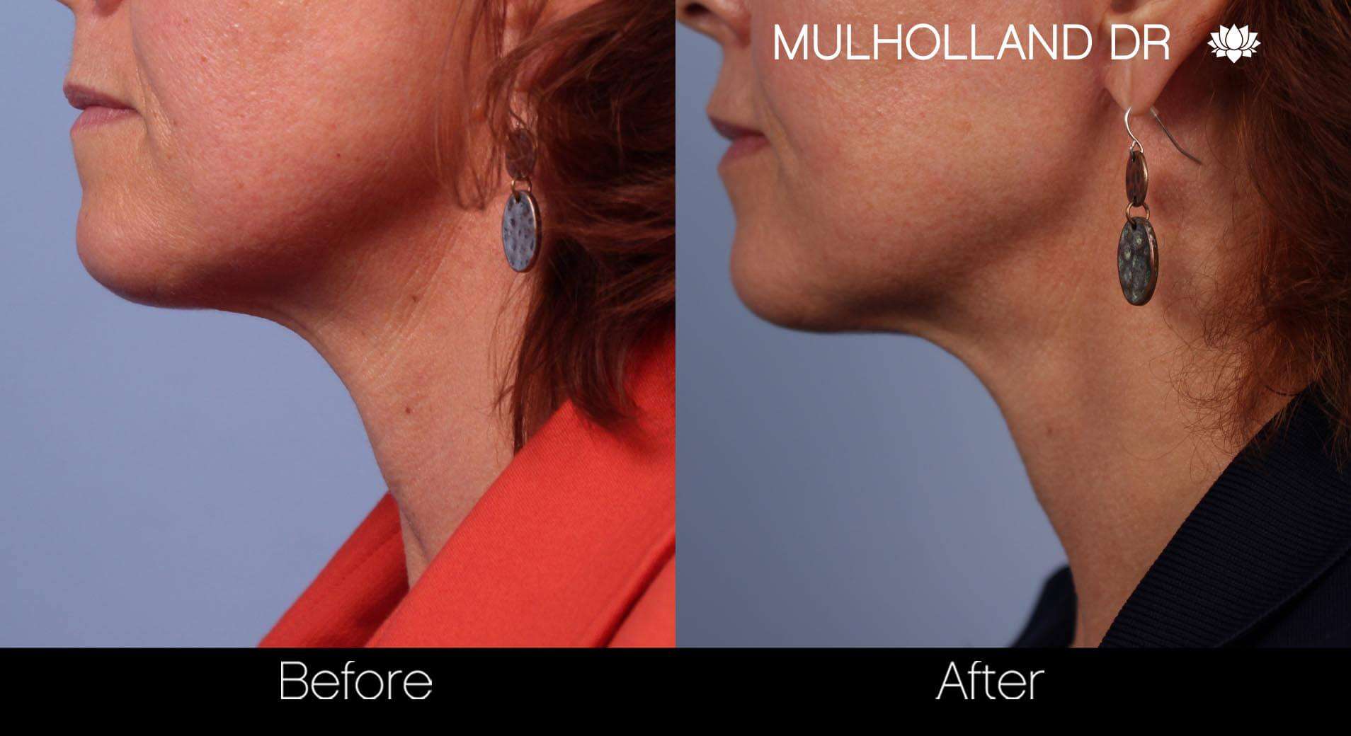 Neck Lift - Before and After Gallery - Patient Photo 53