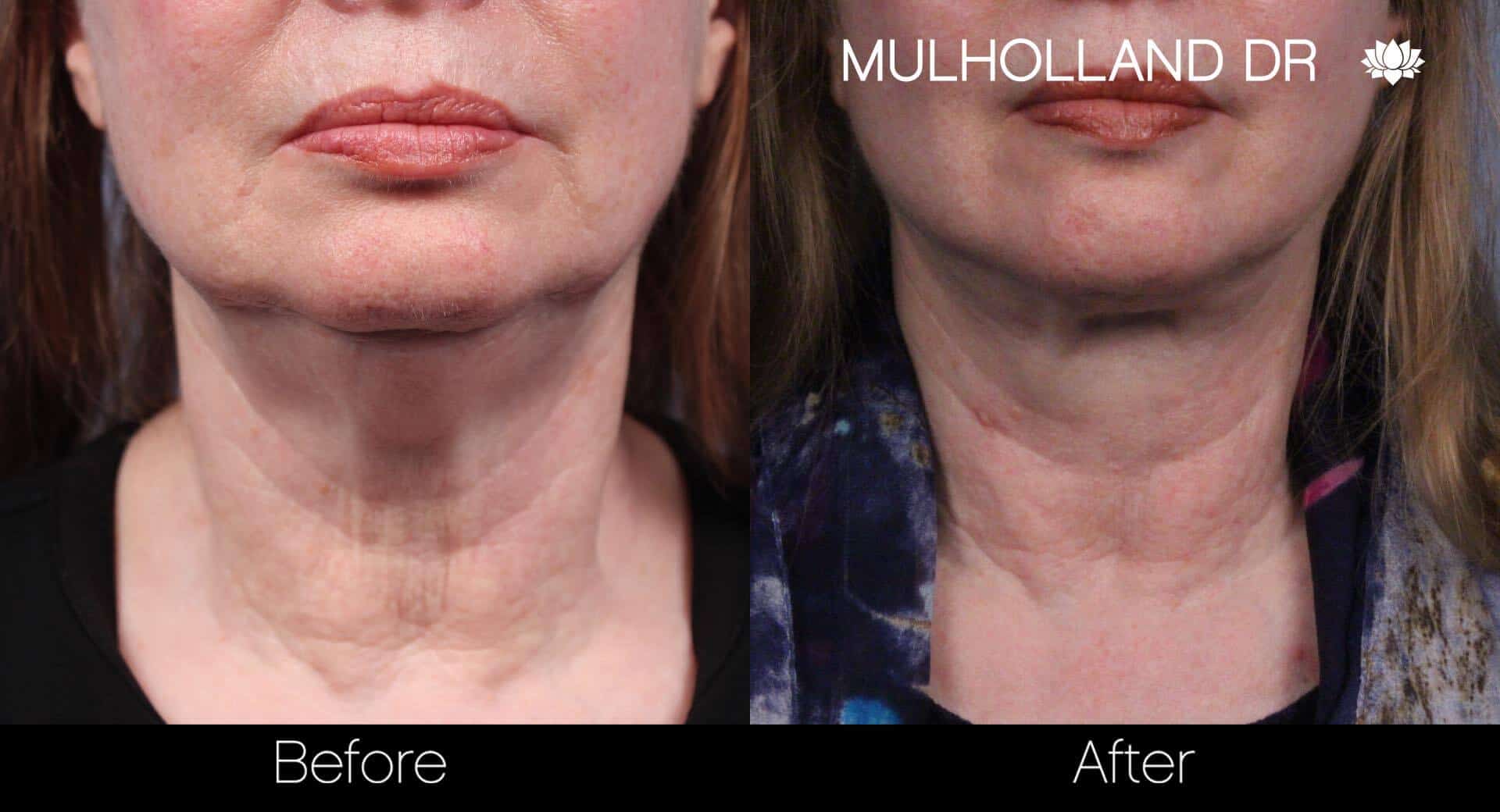 Neck Lift - Before and After Gallery - Patient Photo 54