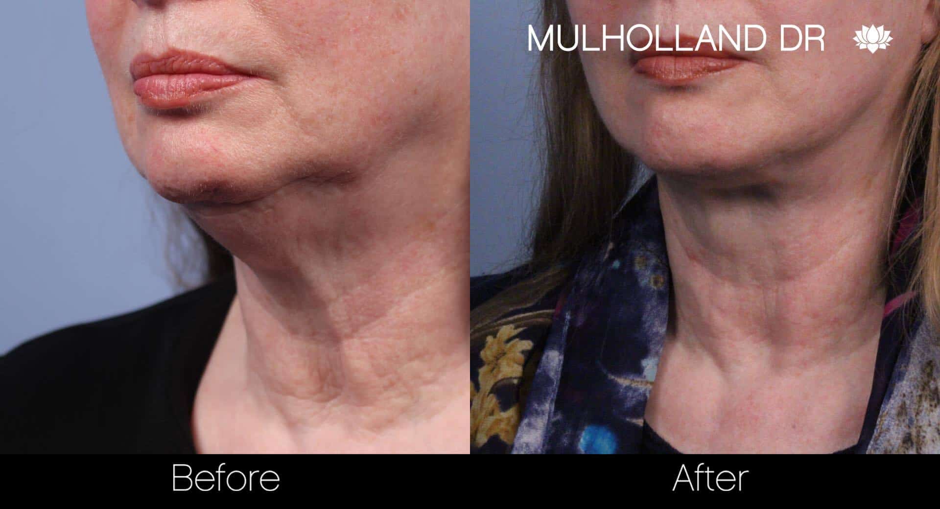 Neck Lift - Before and After Gallery - Patient Photo 55