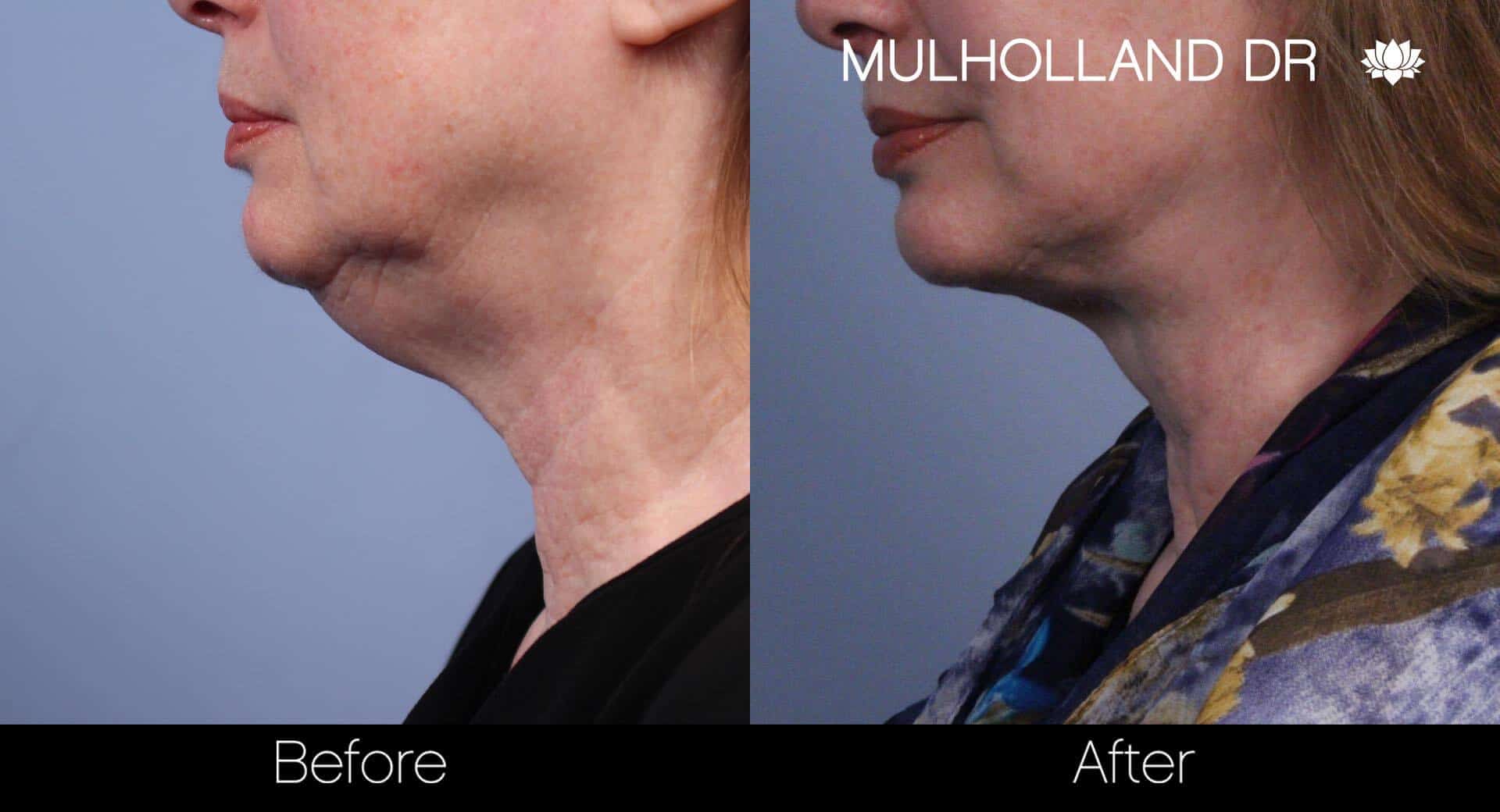 Neck Lift - Before and After Gallery - Patient Photo 56