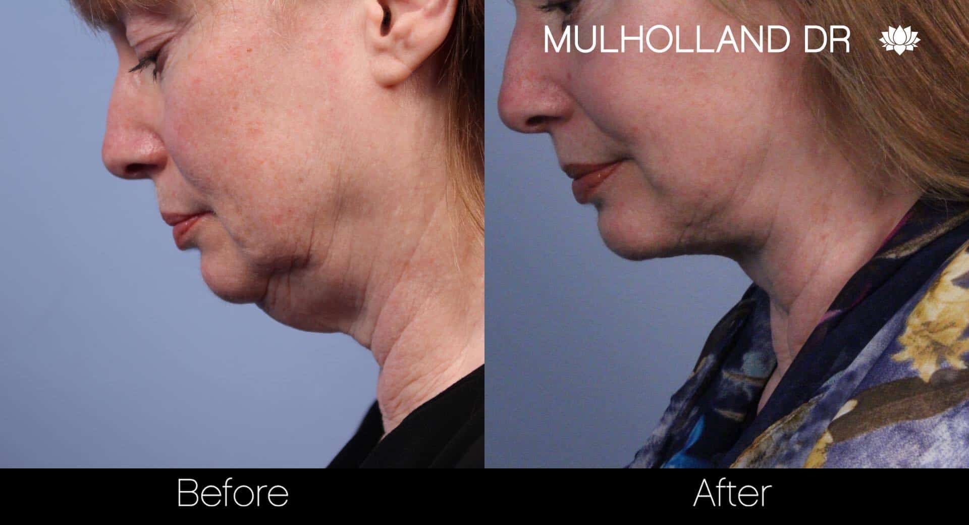 Neck Lift - Before and After Gallery - Patient Photo 57