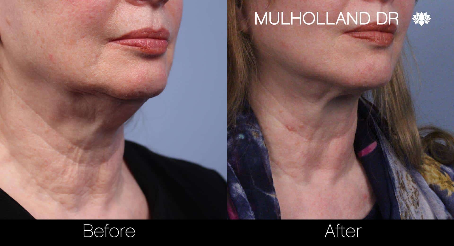 Neck Lift - Before and After Gallery - Patient Photo 58