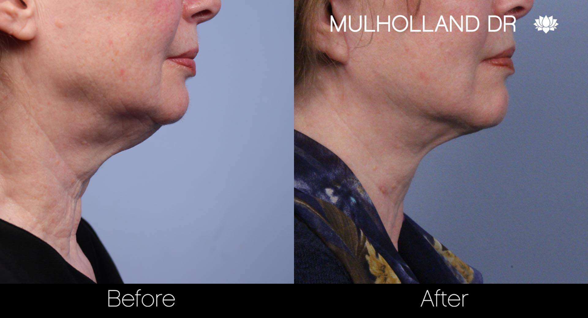 Neck Lift - Before and After Gallery - Patient Photo 59