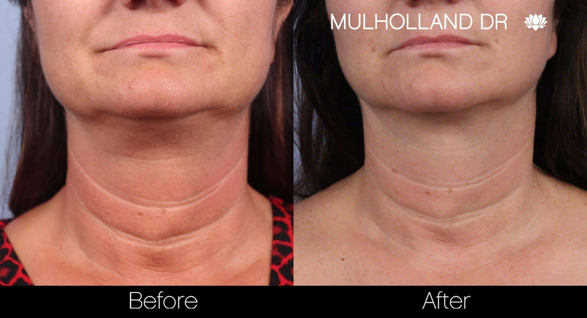 Neck Lift - Before and After Gallery - Patient Photo 61