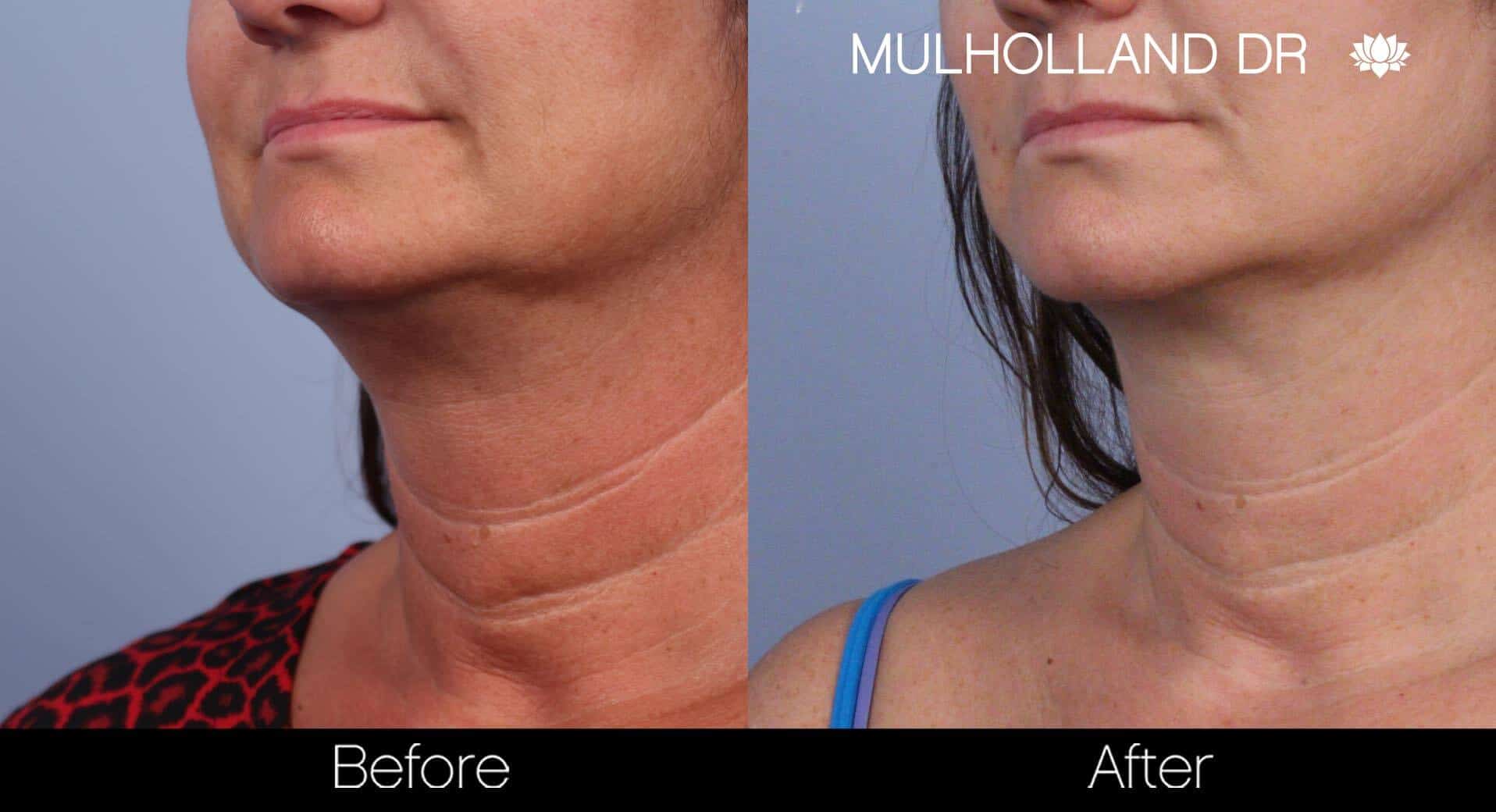 Neck Lift - Before and After Gallery - Patient Photo 62