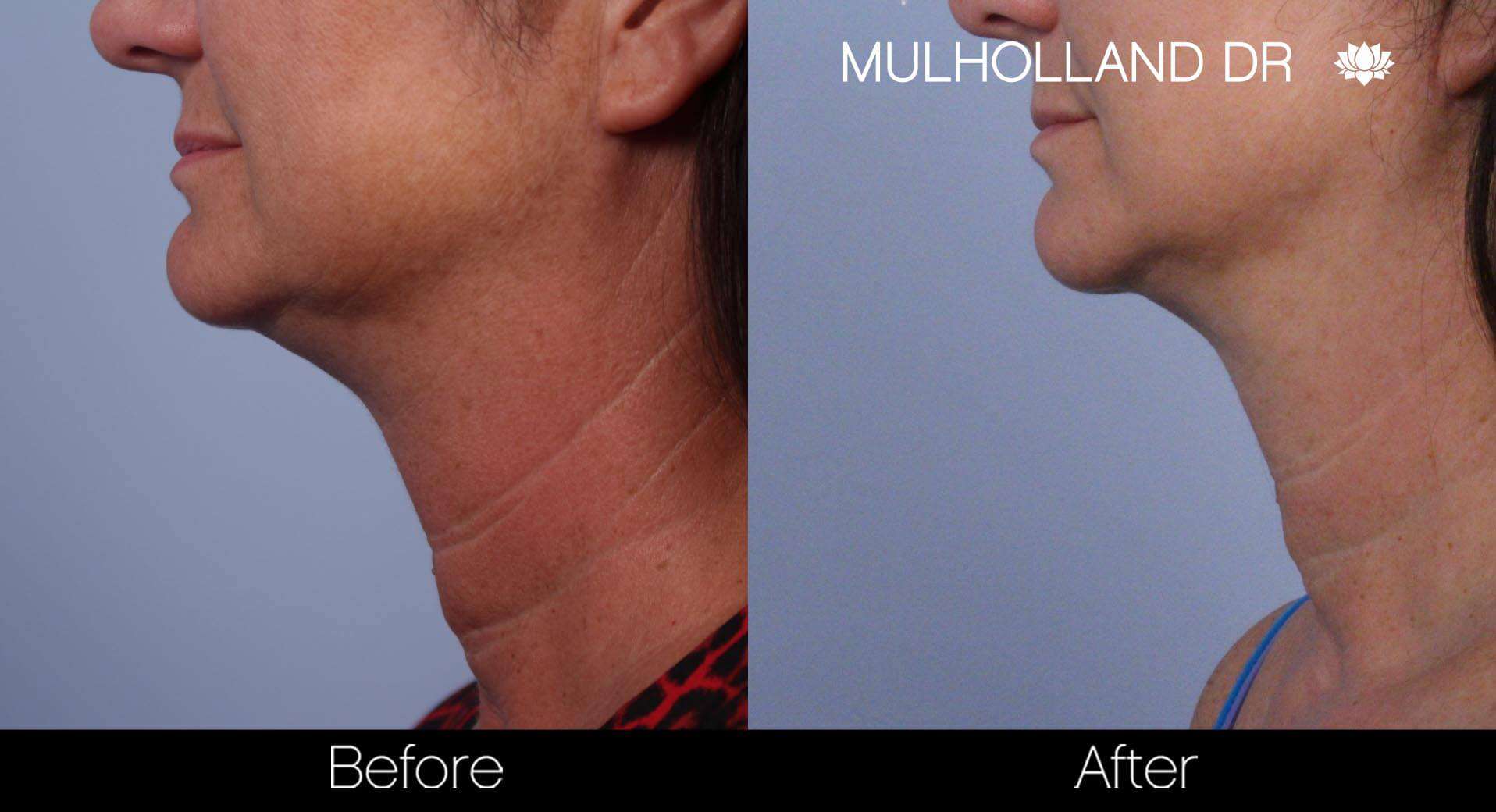 Neck Lift - Before and After Gallery - Patient Photo 63