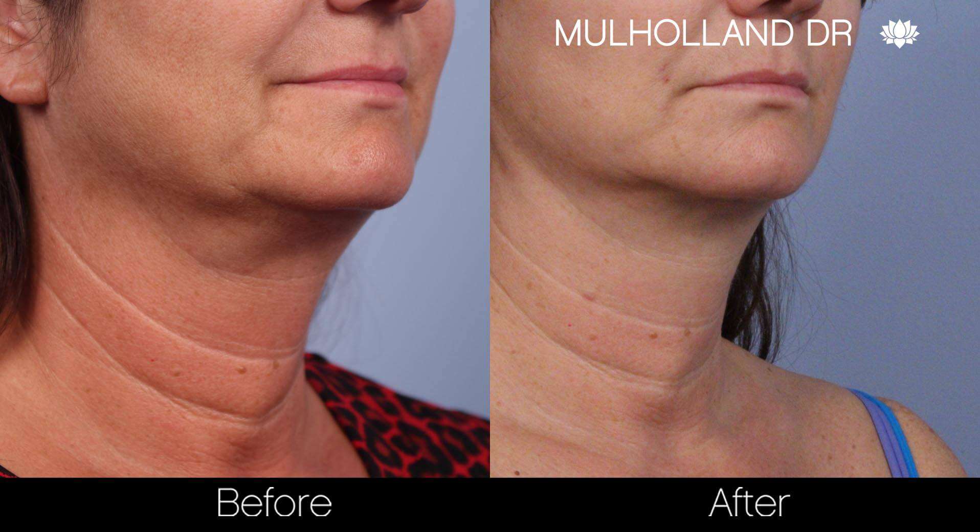 Neck Lift - Before and After Gallery - Patient Photo 64