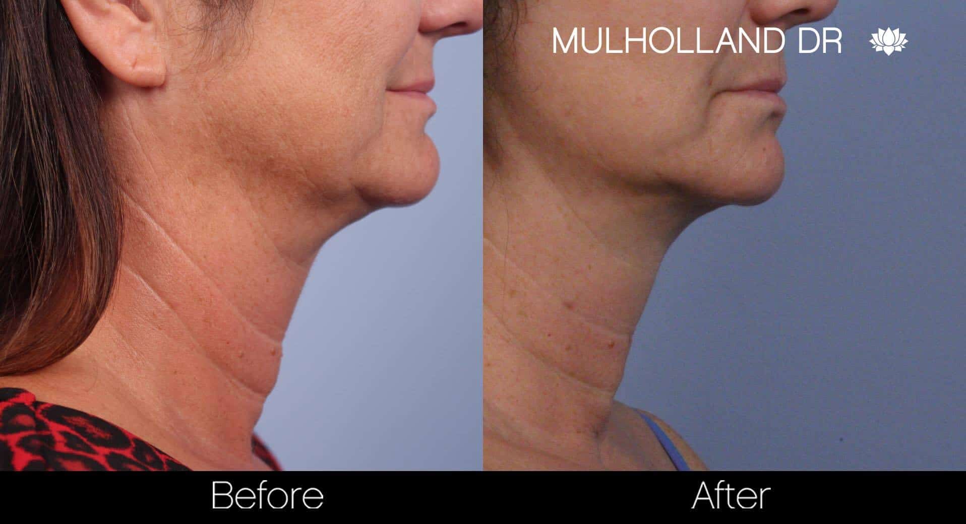 Neck Lift - Before and After Gallery - Patient Photo 65