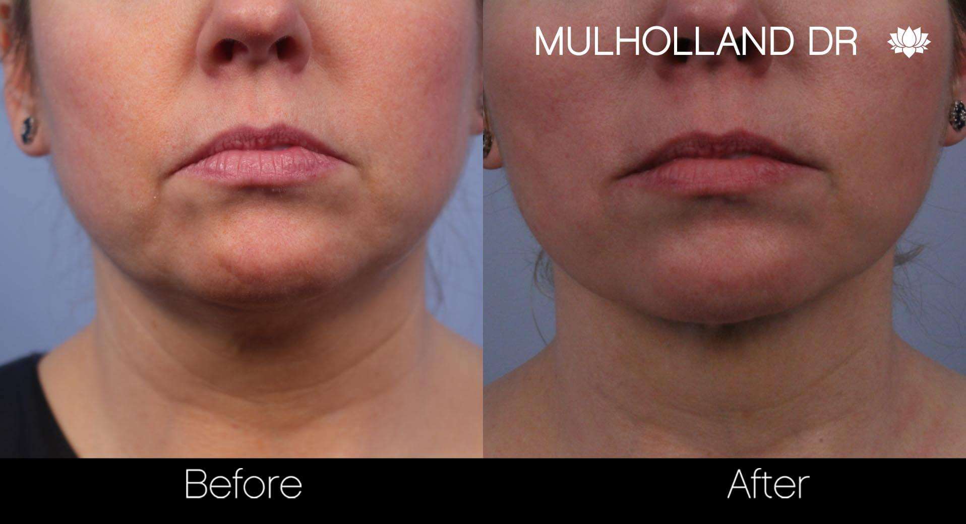 Neck Lift - Before and After Gallery - Patient Photo 66
