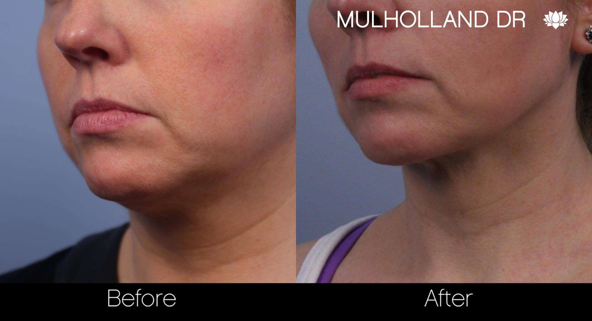 Neck Lift - Before and After Gallery - Patient Photo 67