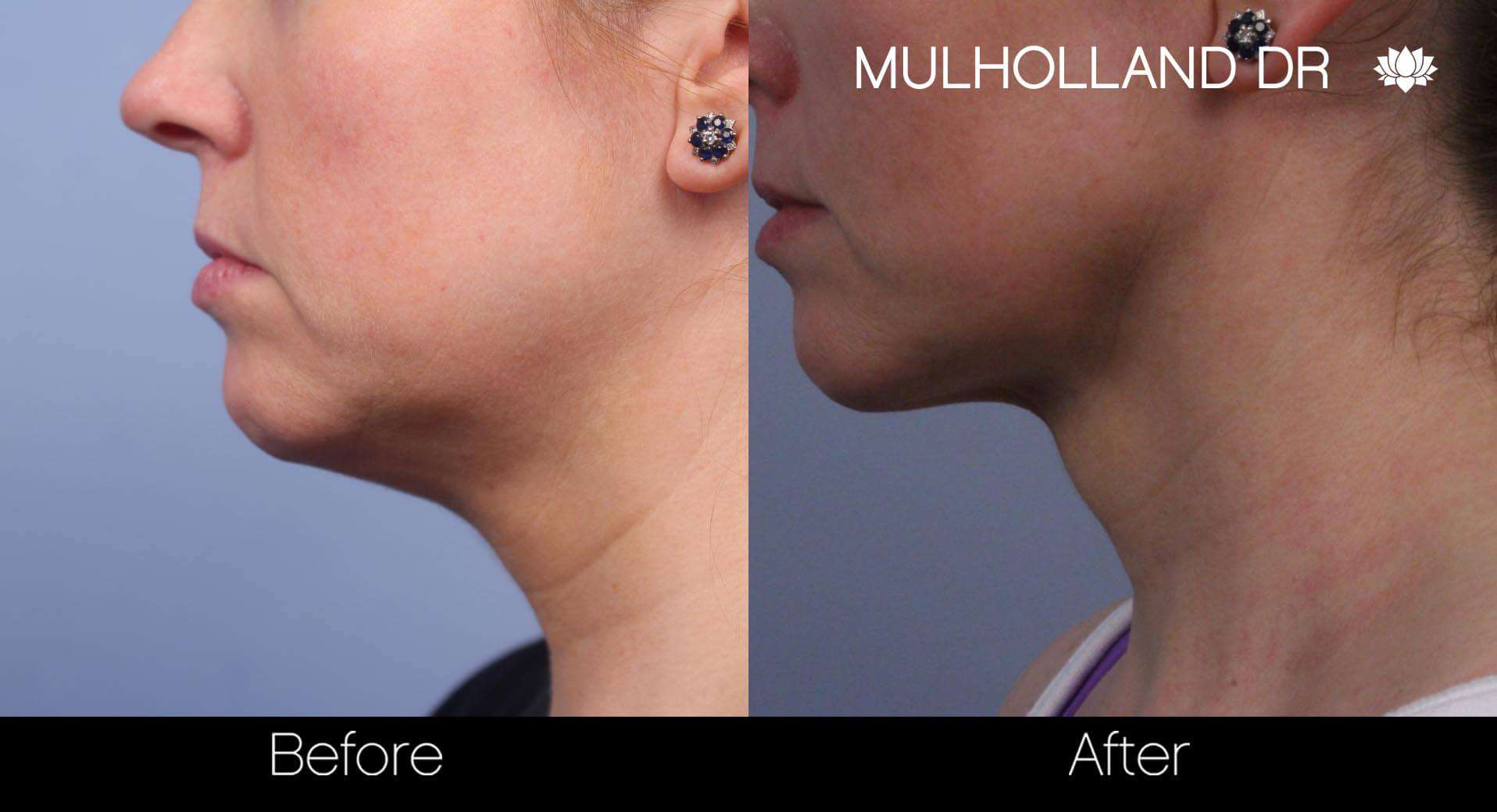 Neck Lift - Before and After Gallery - Patient Photo 68