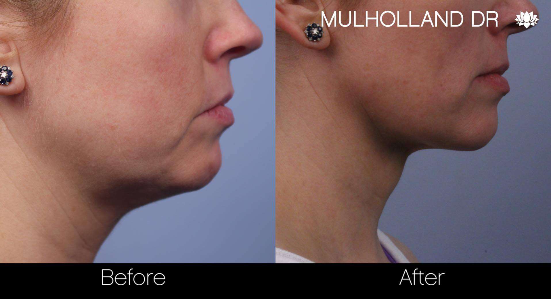 Neck Lift - Before and After Gallery - Patient Photo 70