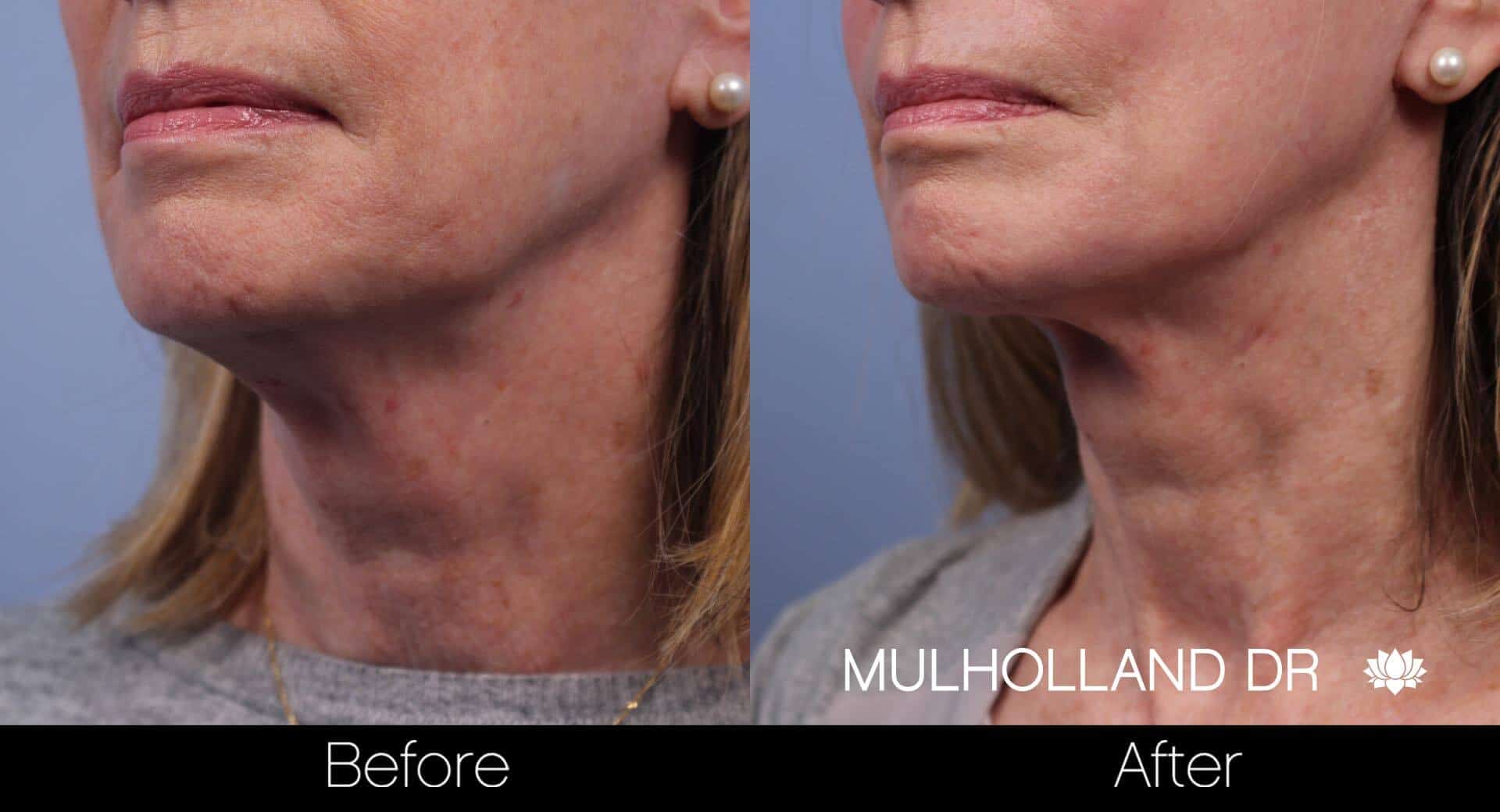 Neck Lift - Before and After Gallery - Patient Photo 72