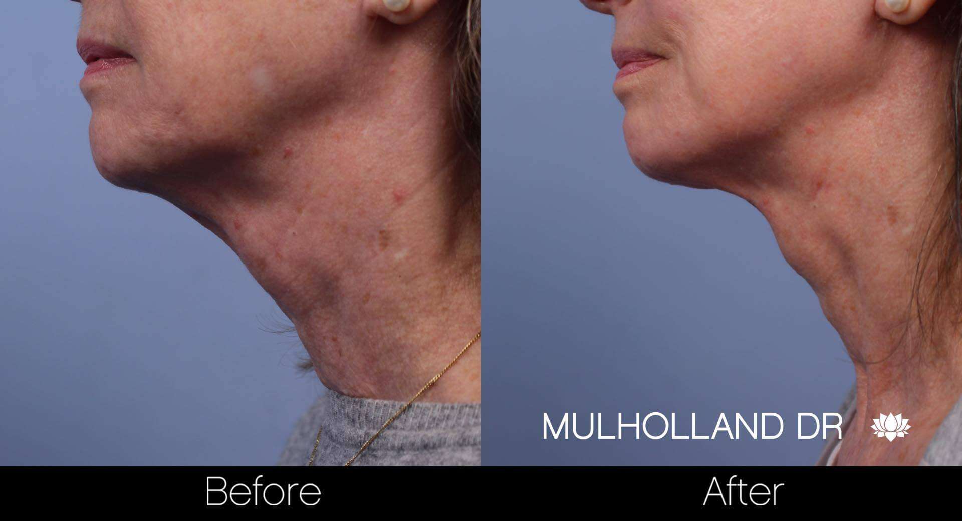 Neck Lift - Before and After Gallery - Patient Photo 73