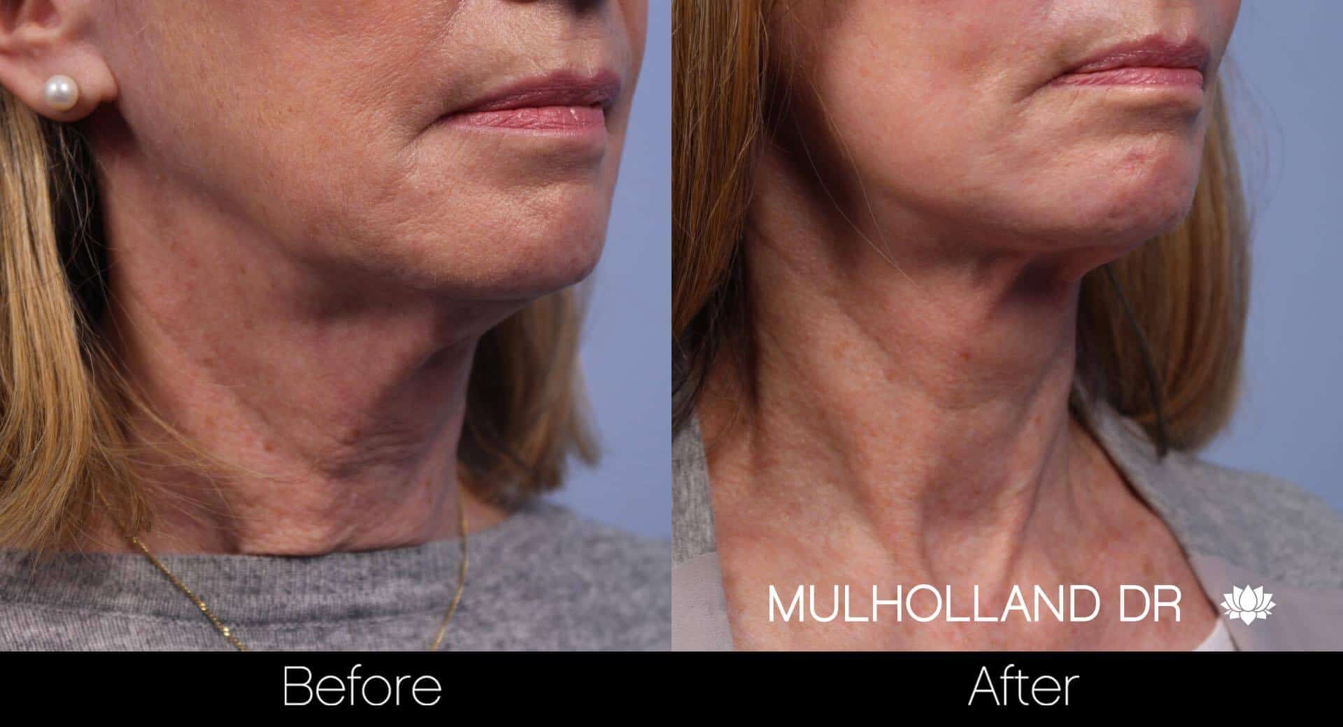 Neck Lift - Before and After Gallery - Patient Photo 75