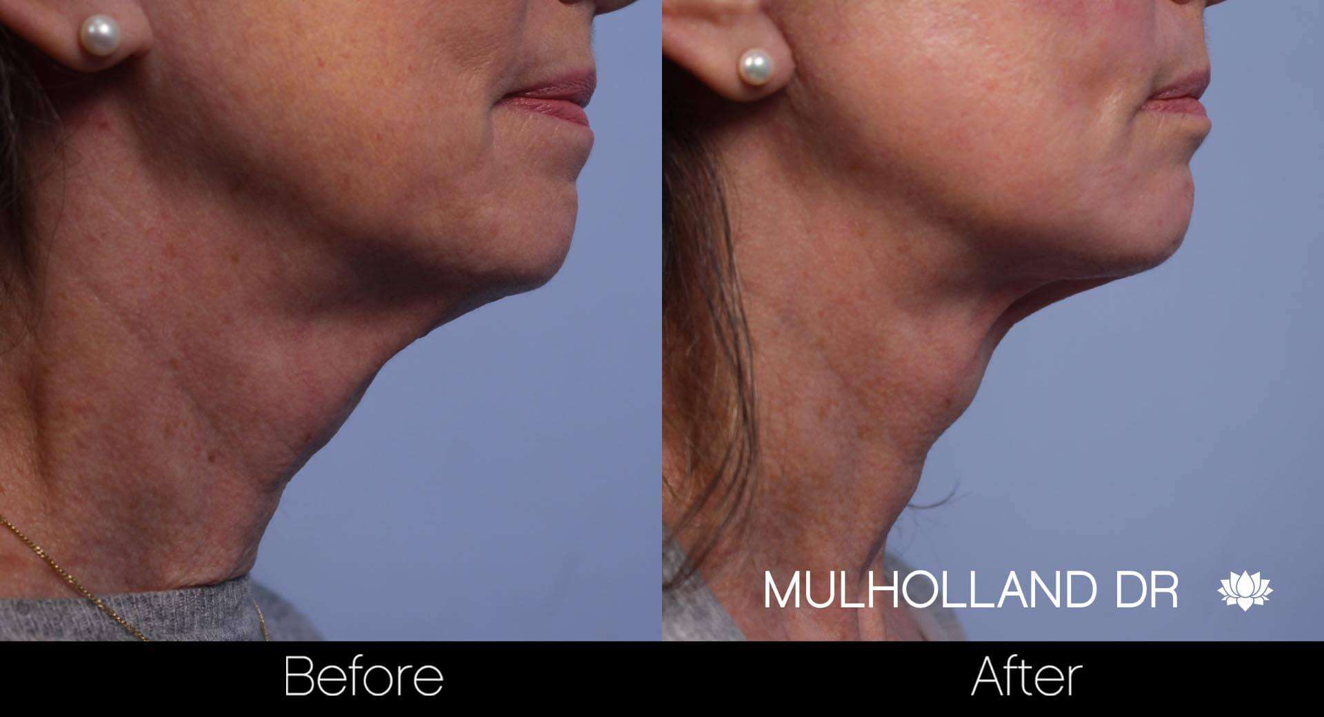Neck Lift - Before and After Gallery - Patient Photo 76
