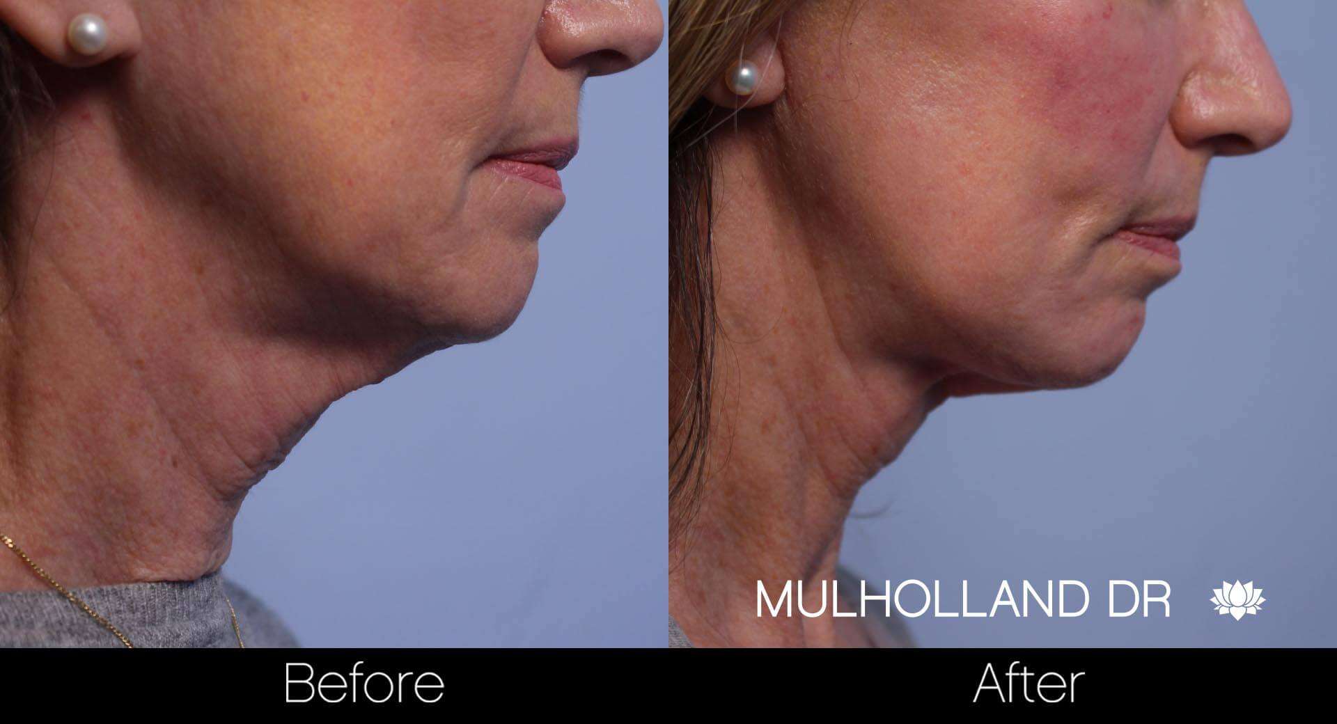 Neck Lift - Before and After Gallery - Patient Photo 77