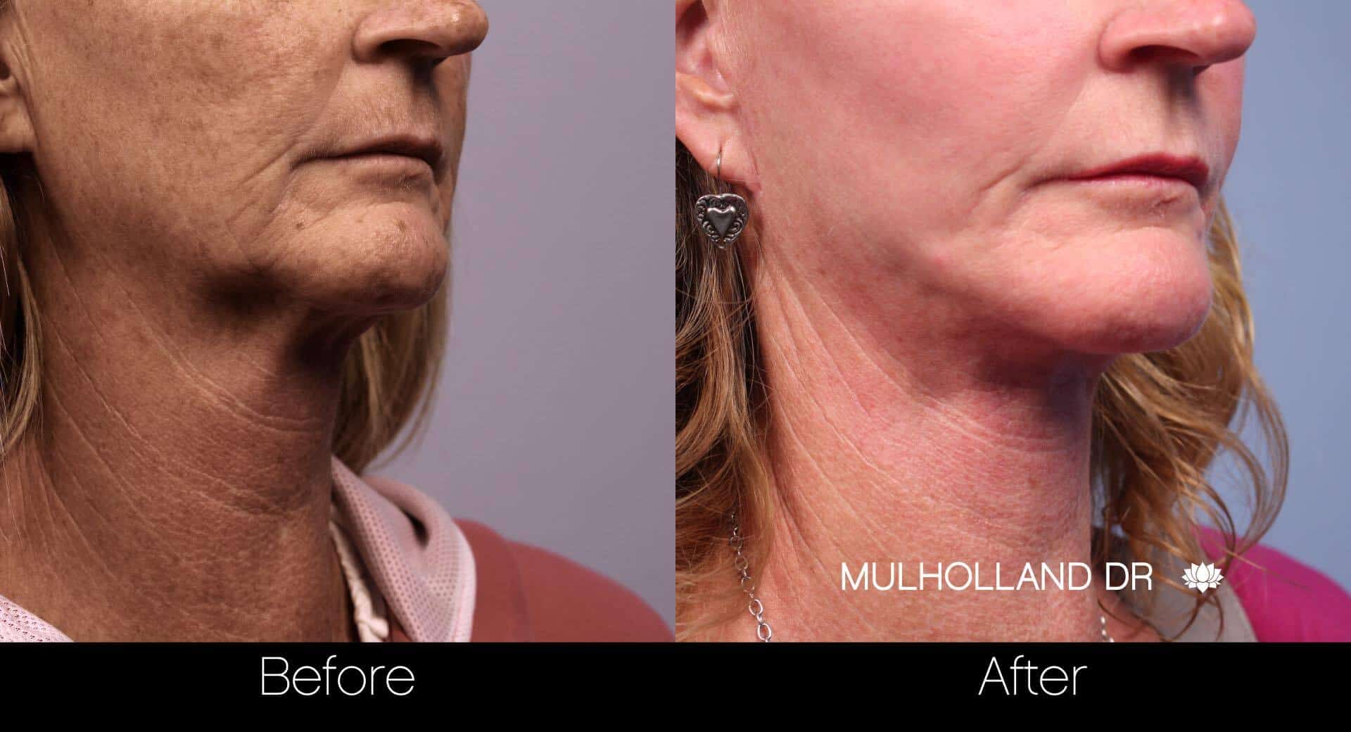 Neck Lift - Before and After Gallery - Patient Photo 78