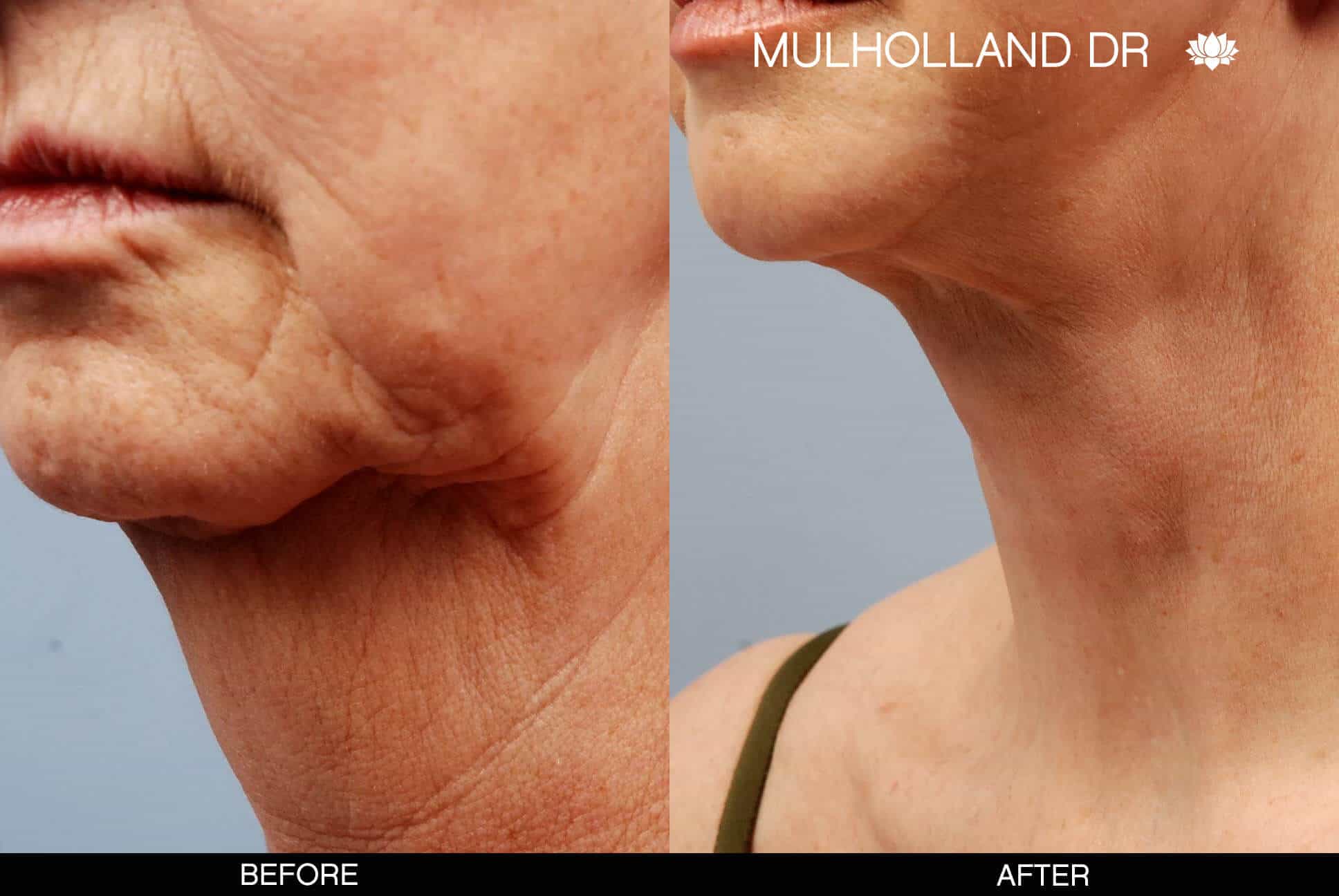 Neck Lift - Before and After Gallery - Patient Photo 8
