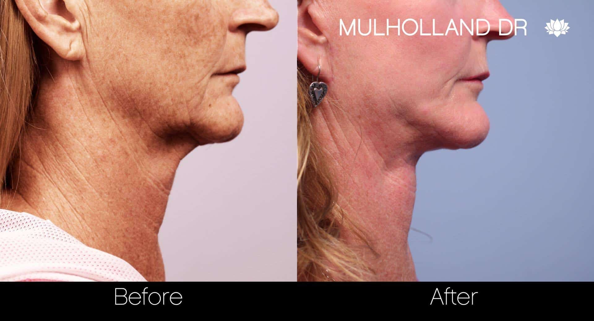 Neck Lift - Before and After Gallery - Patient Photo 80