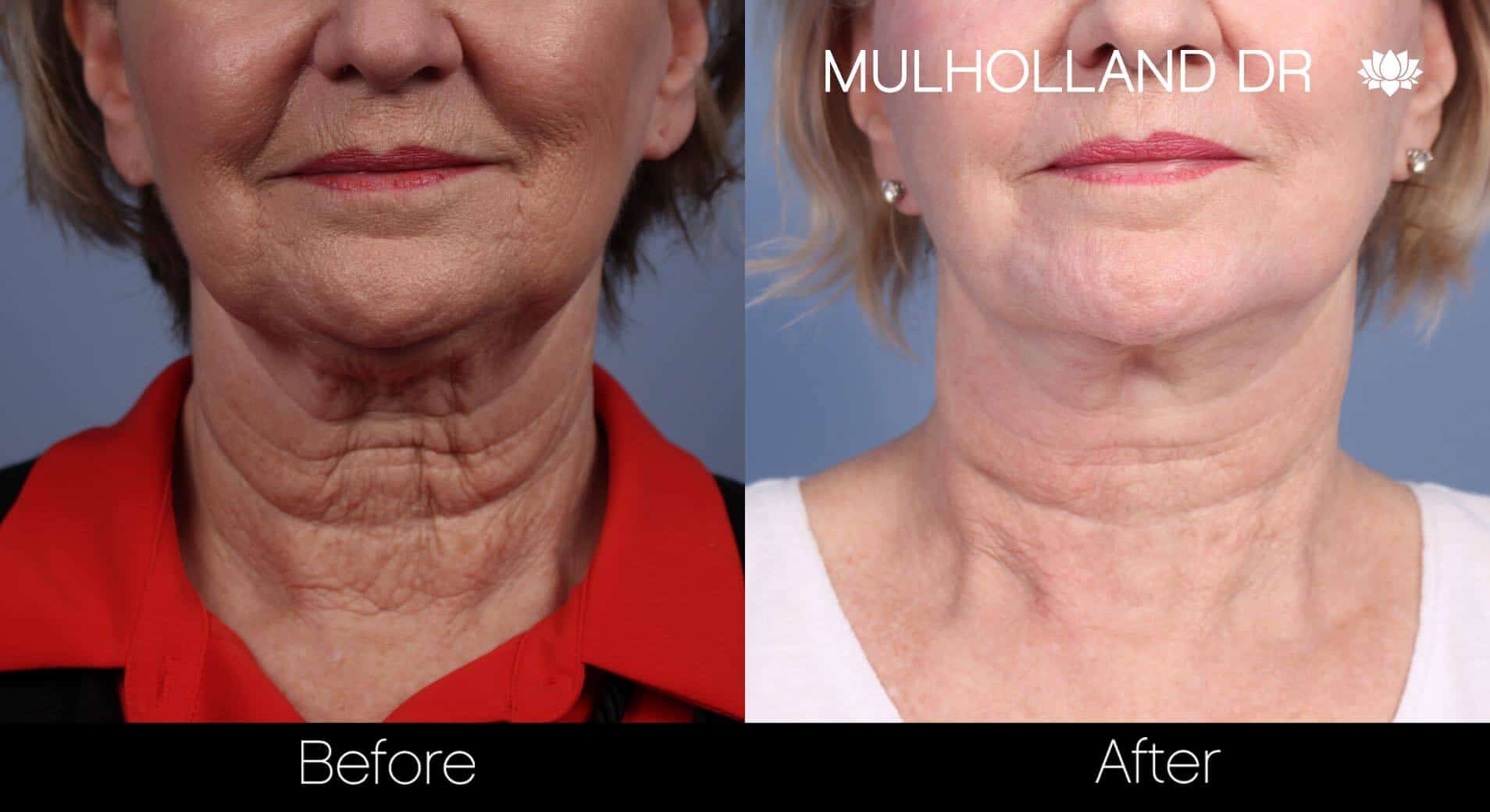 Neck Lift - Before and After Gallery - Patient Photo 82