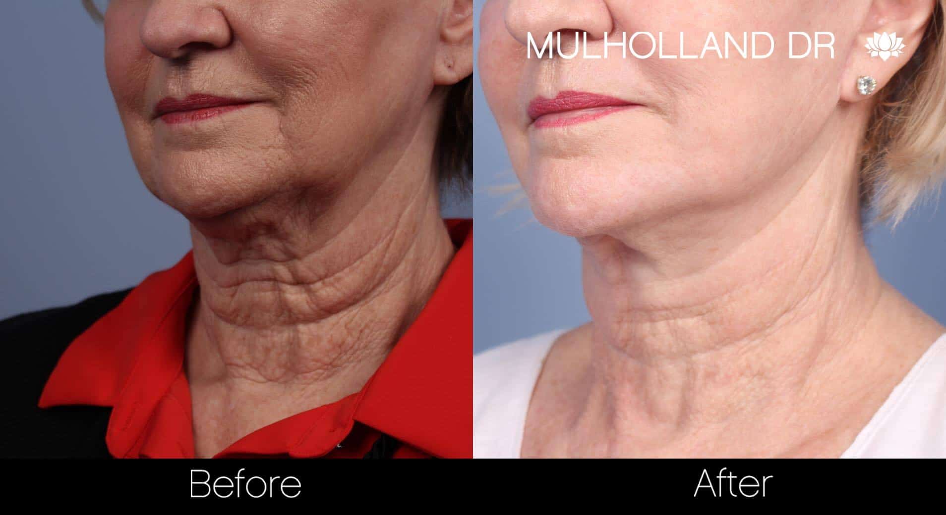 Neck Lift - Before and After Gallery - Patient Photo 83