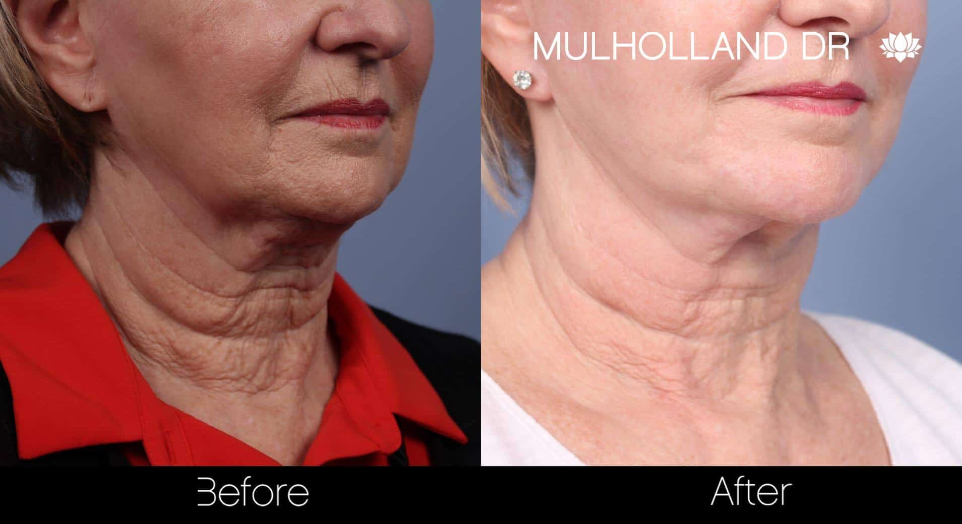Neck Lift - Before and After Gallery - Patient Photo 84