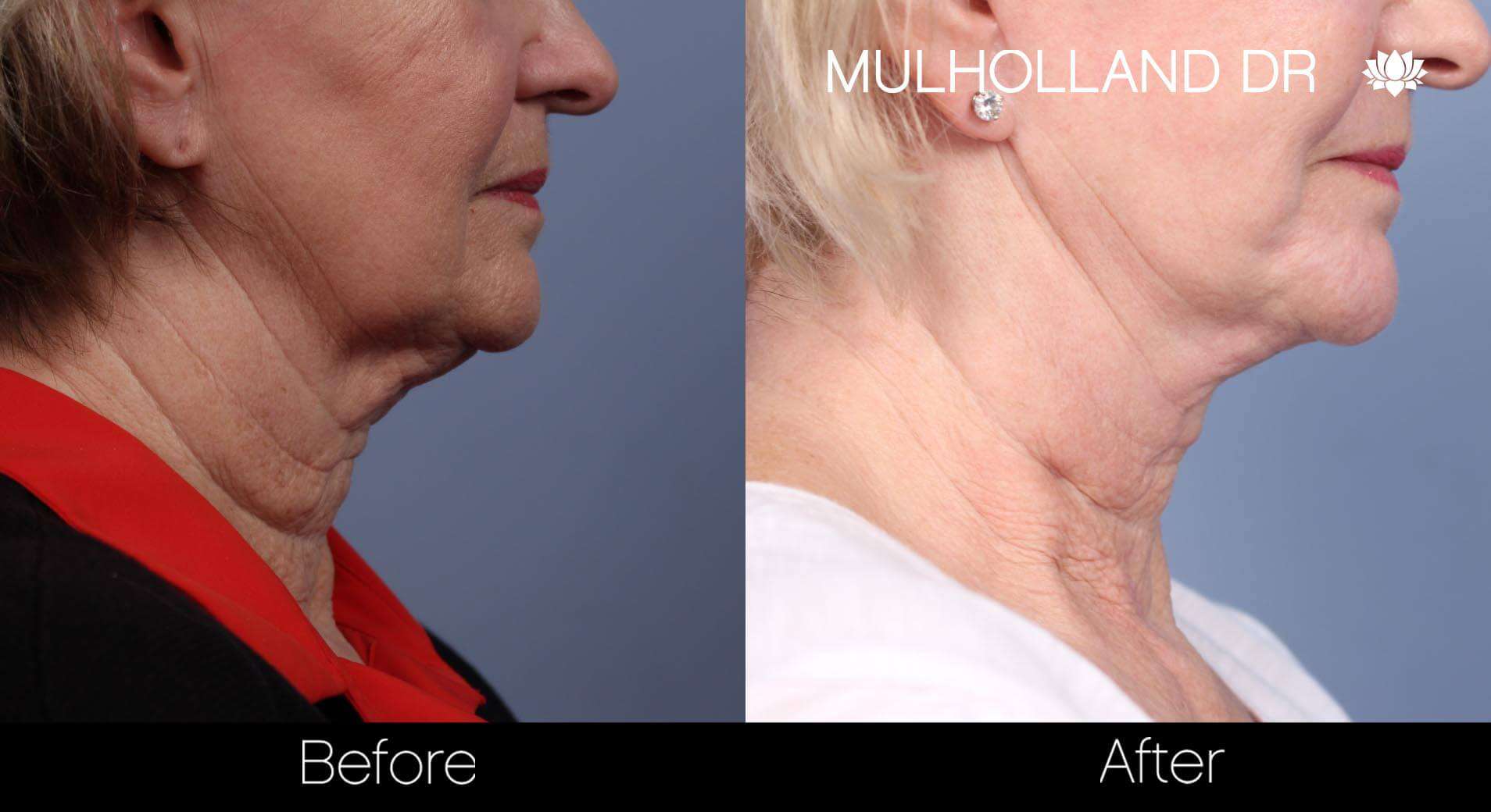 Neck Lift - Before and After Gallery - Patient Photo 85