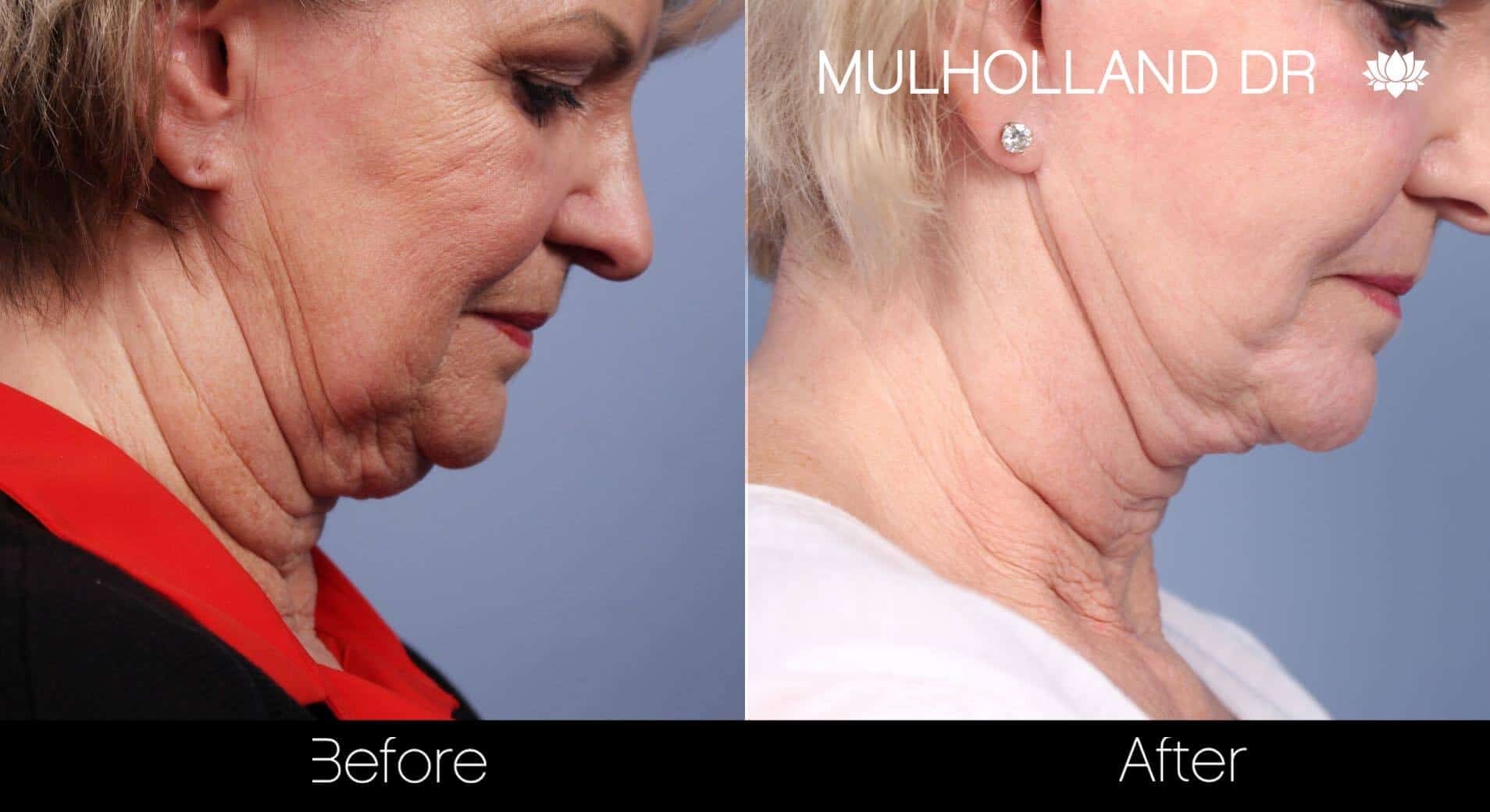 Neck Lift - Before and After Gallery - Patient Photo 86