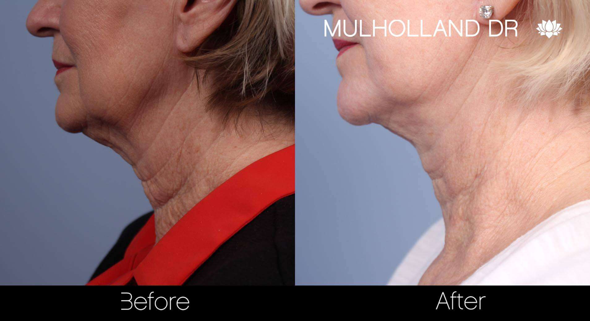 Neck Lift - Before and After Gallery - Patient Photo 87