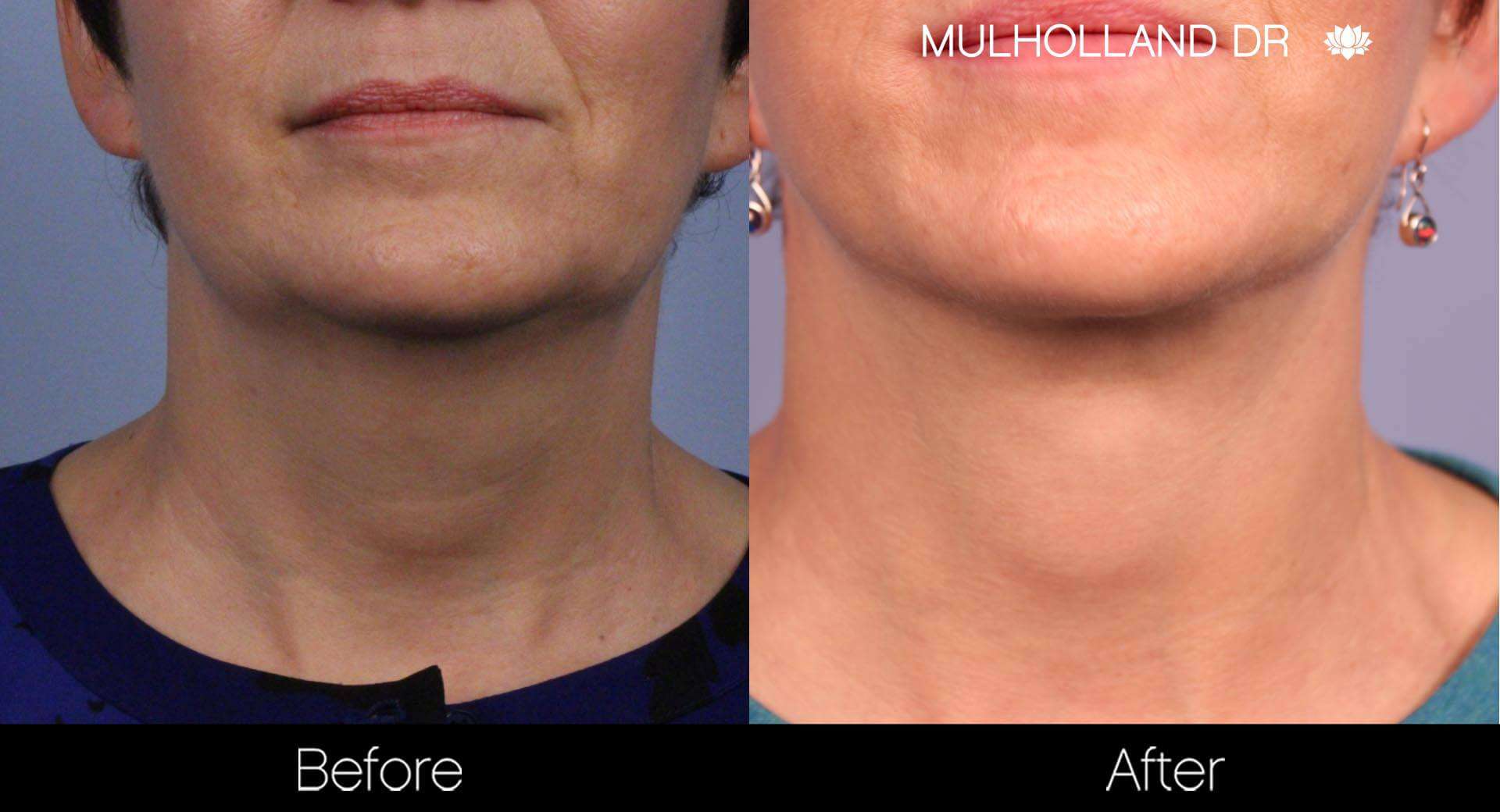 Neck Lift - Before and After Gallery - Patient Photo 88